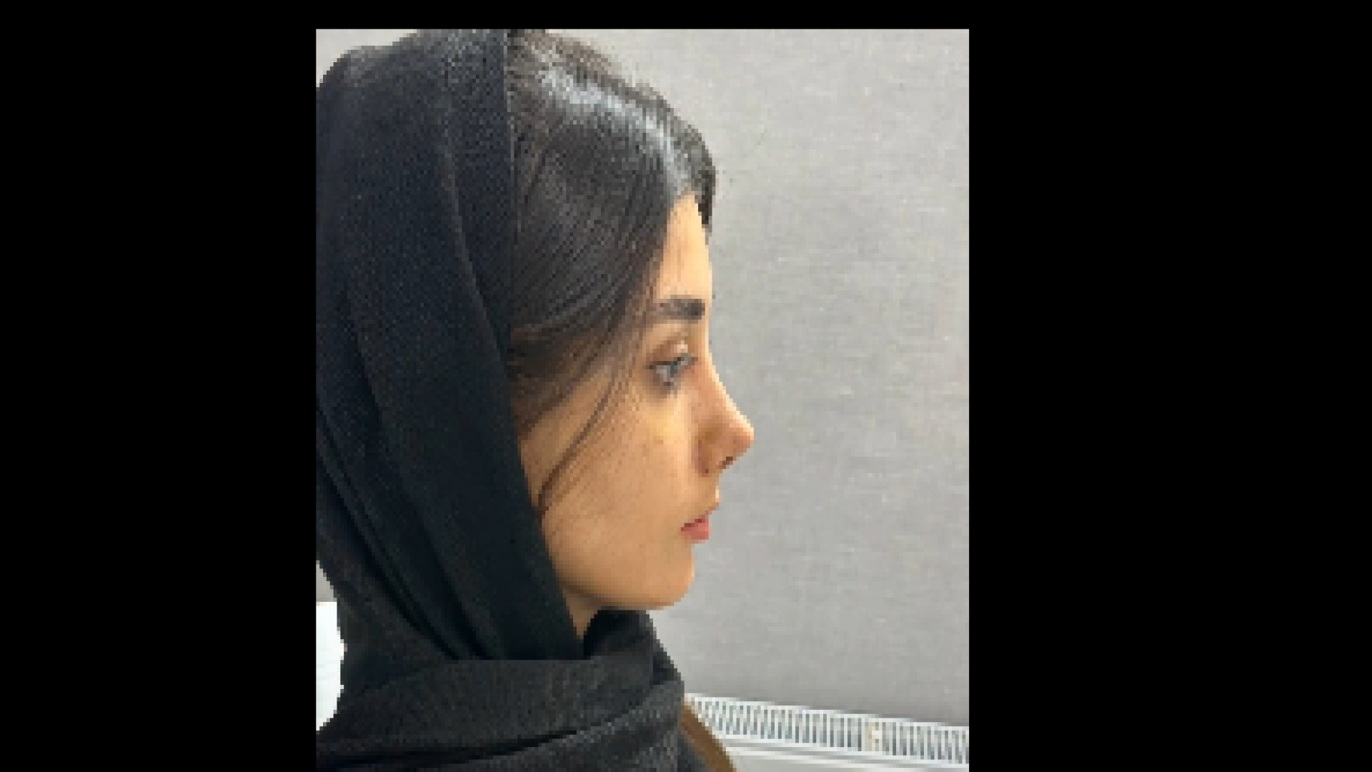 نمونه کار رینوپلاستی دکتر معصومه حسین پور