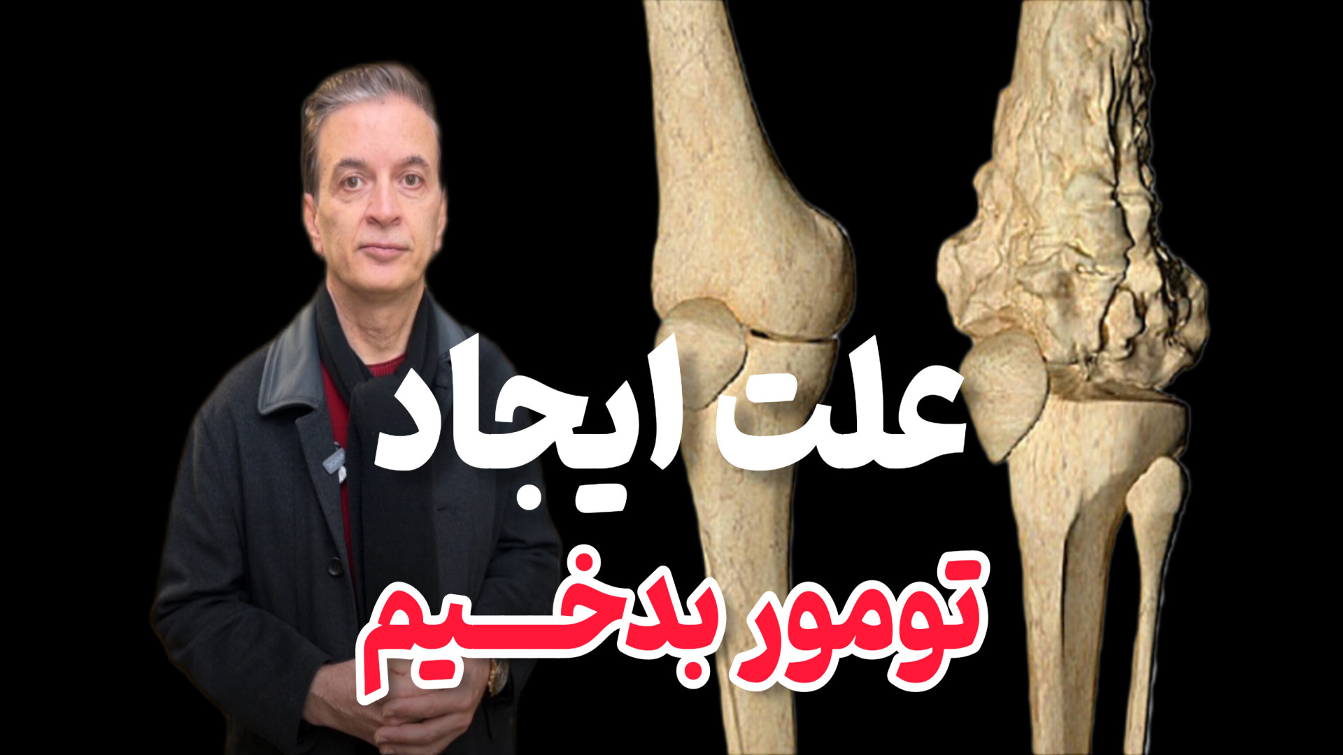 علت ایجاد تومور بدخیم دکتر محمود جعفر بیگلو