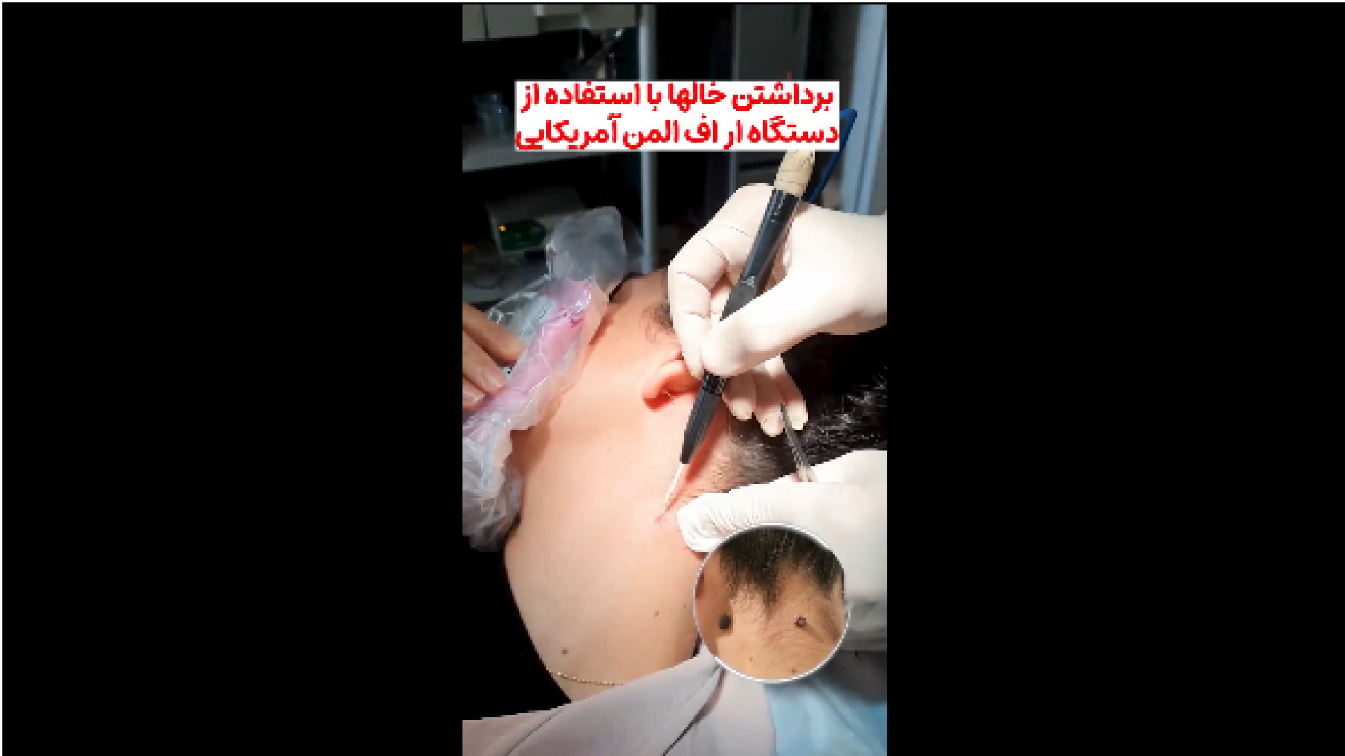 جدید ترین روش برداشتن خال دکتر ایمان روغنی جراح و متخصص پوست و مو