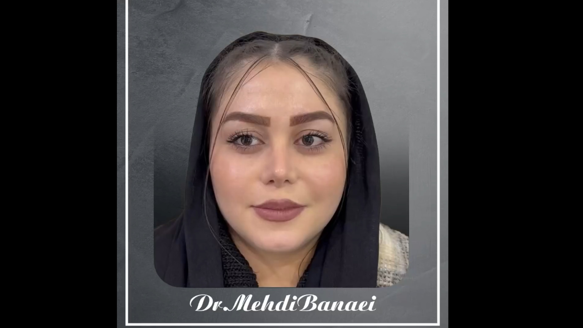 نگاهی به نتیجه جراحی بینی گوشتی بعد از 8 ماه