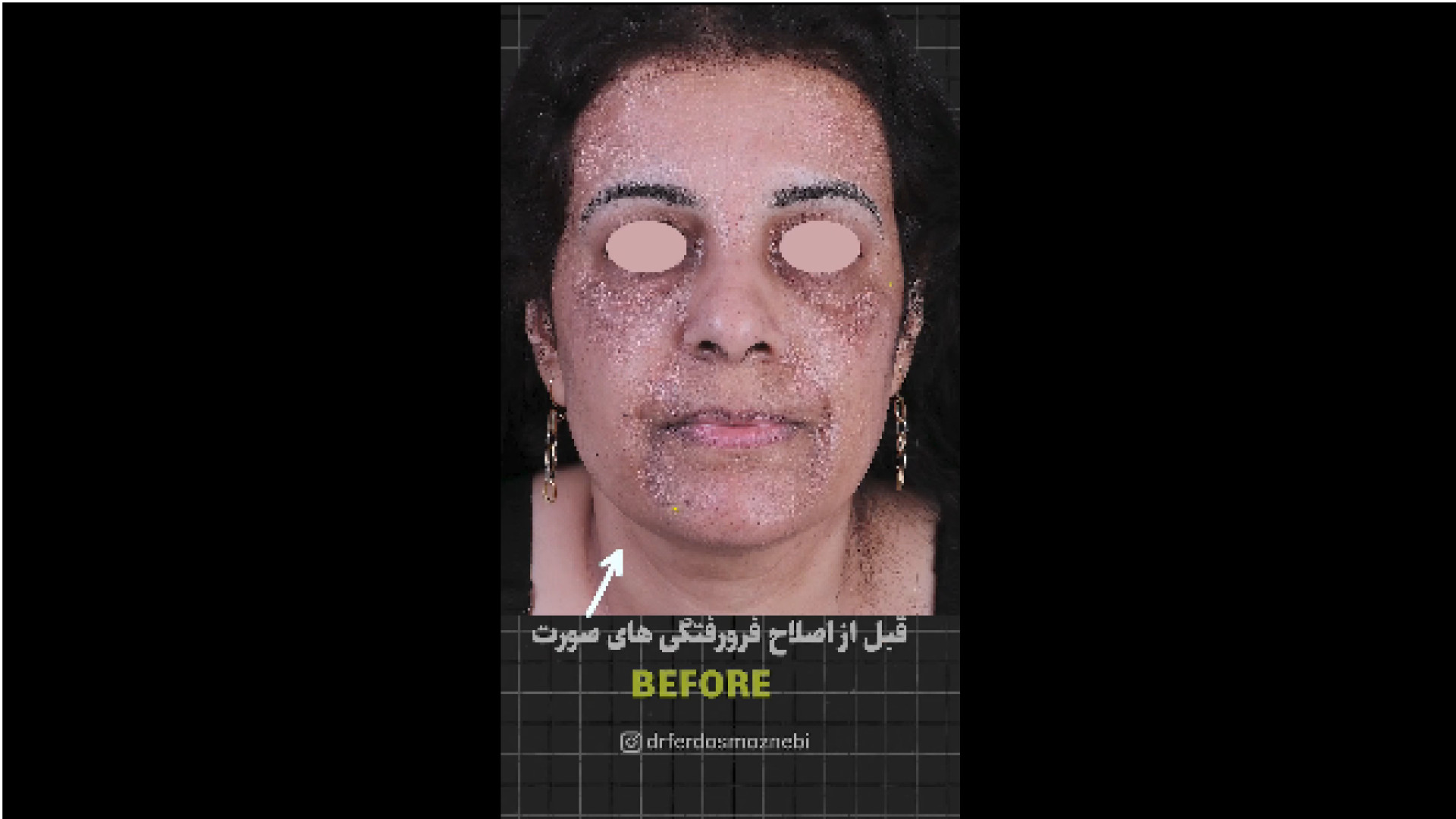 قبل و بعد تزریق چربی دکتر فردوس مذنبی