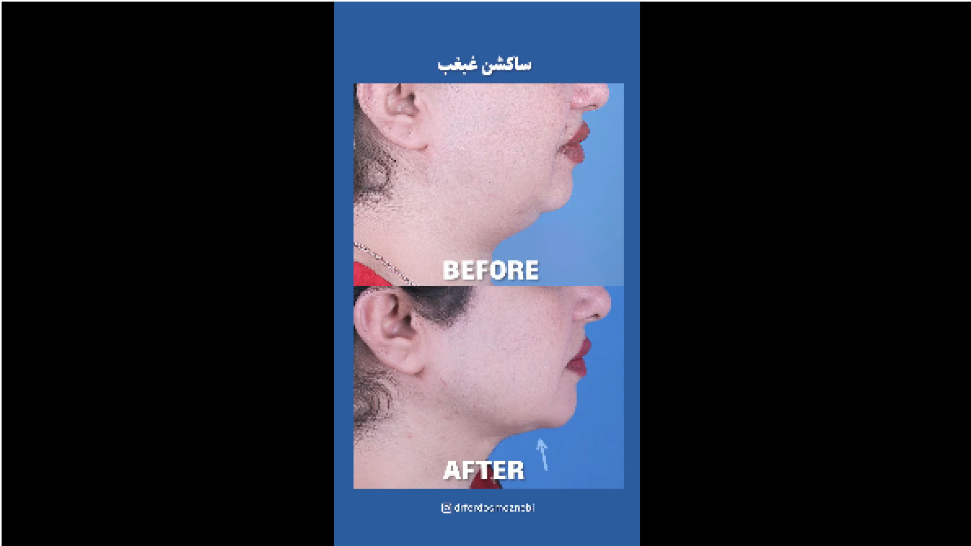 قبل و بعد ساکشن غبغب دکتر فردوس مذنبی