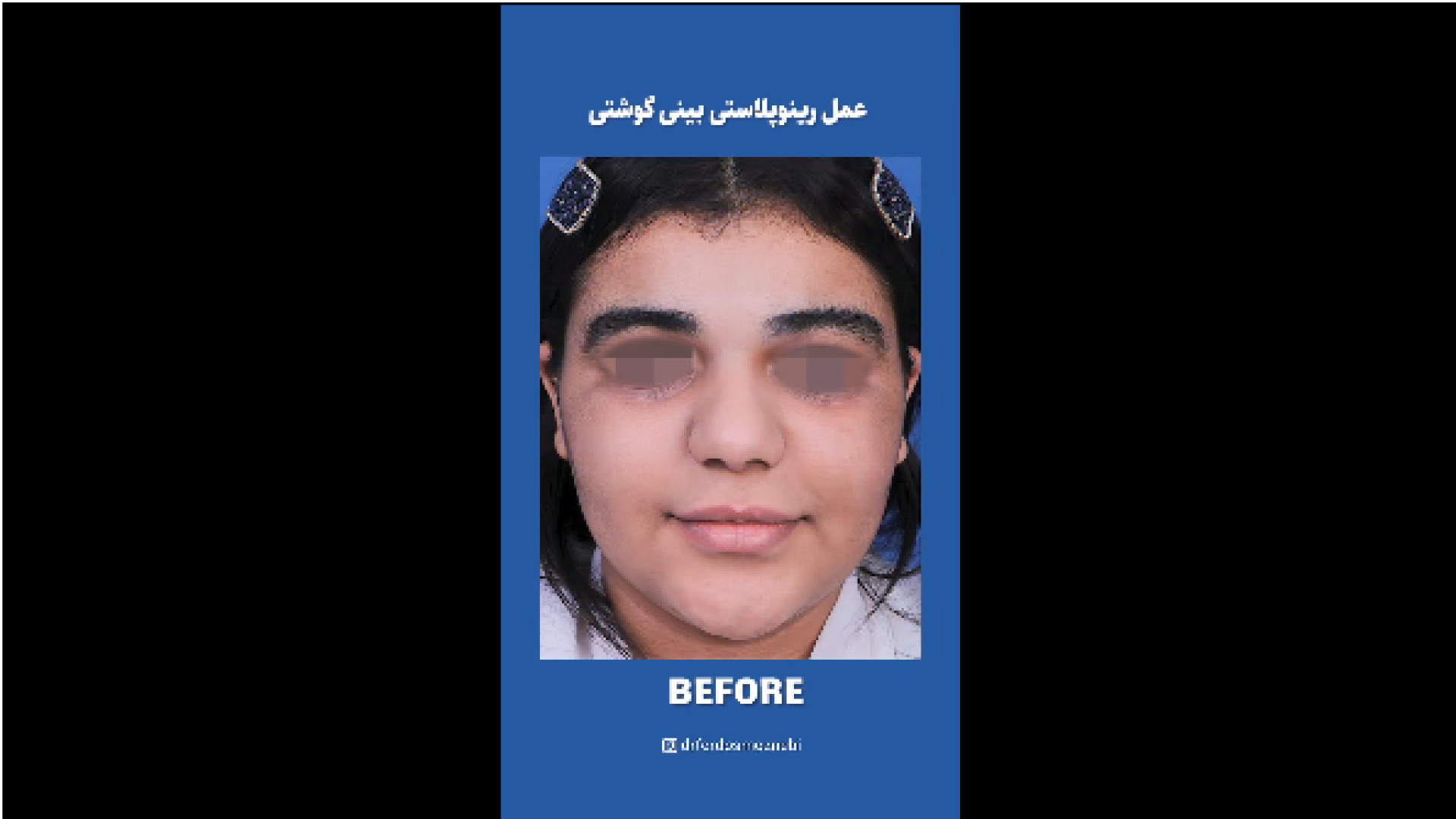 عمل بینی گوشتی دکتر فردوس مذنبی