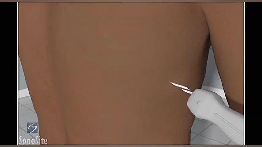 نحوه انجام- ویدئوی سه بعدی آزمایش توراسنتز هدایت شده با سونوگرافی کمند امیرسلیمانی