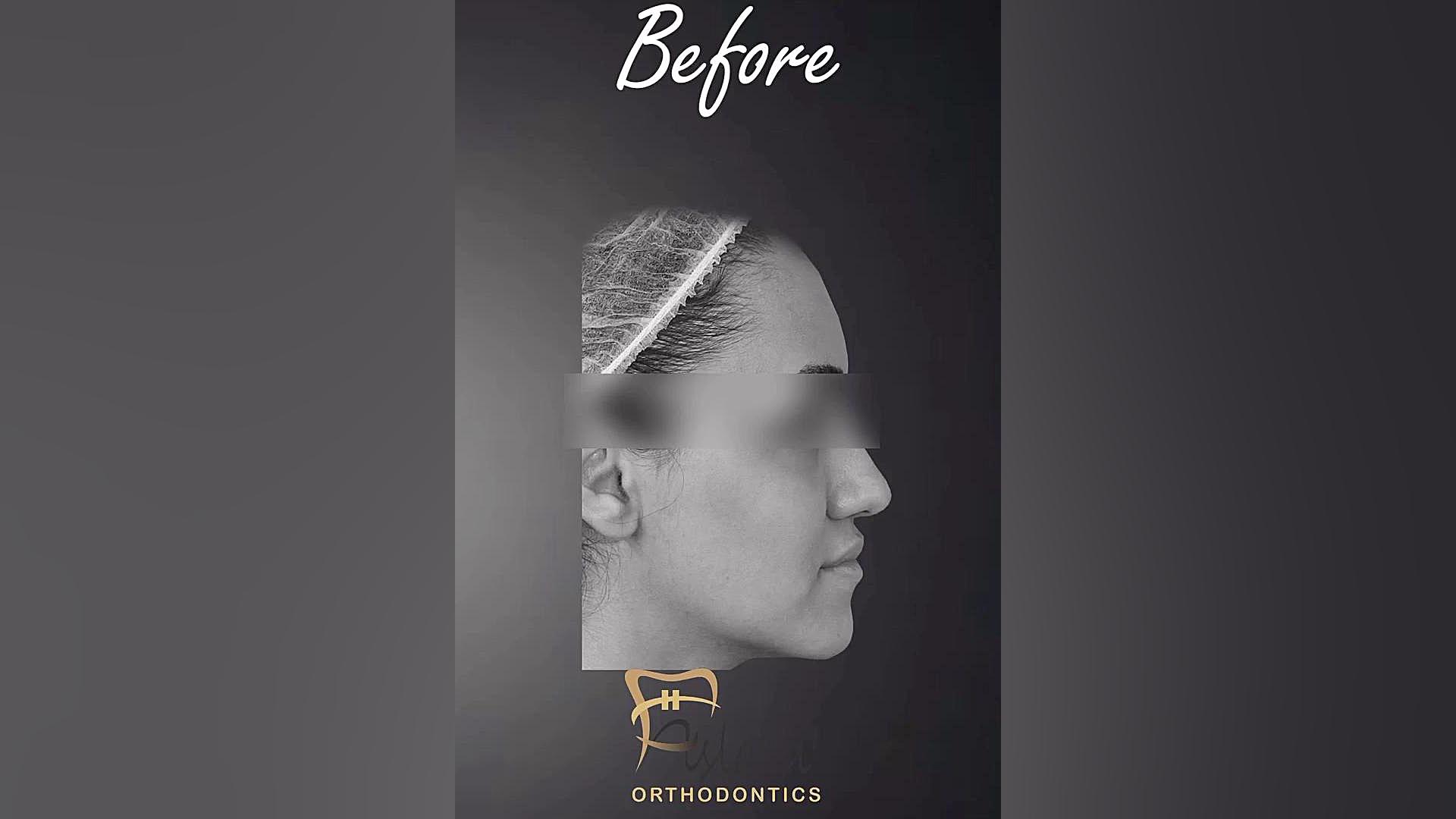 ارتودنسی و جراحی فک (ارتوسرجری) برای عقب بردن فک پایین بیماری آمیلوئیدوز فامیلیال