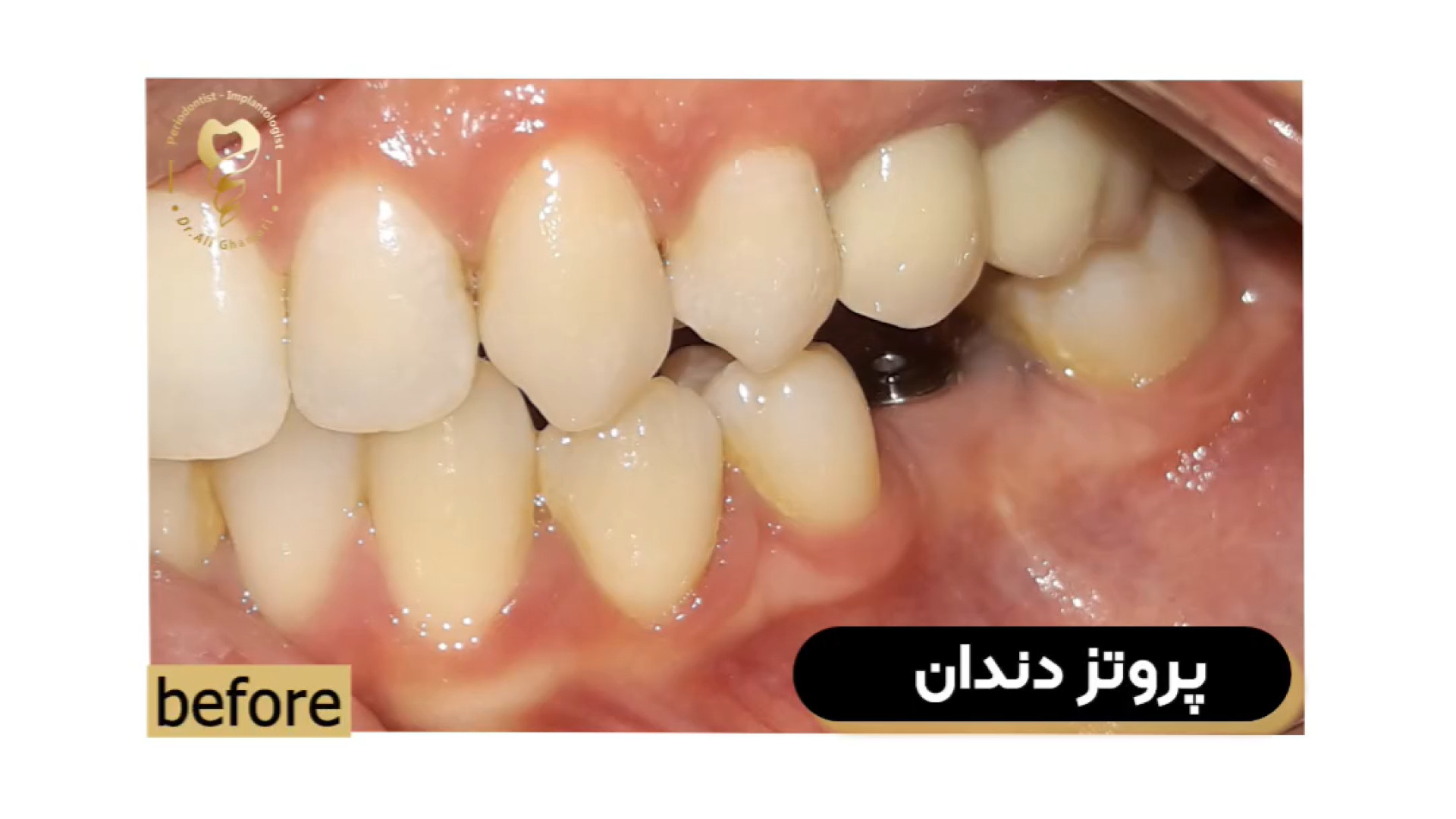 فیلم پروتز دندان دندان مصنوعی