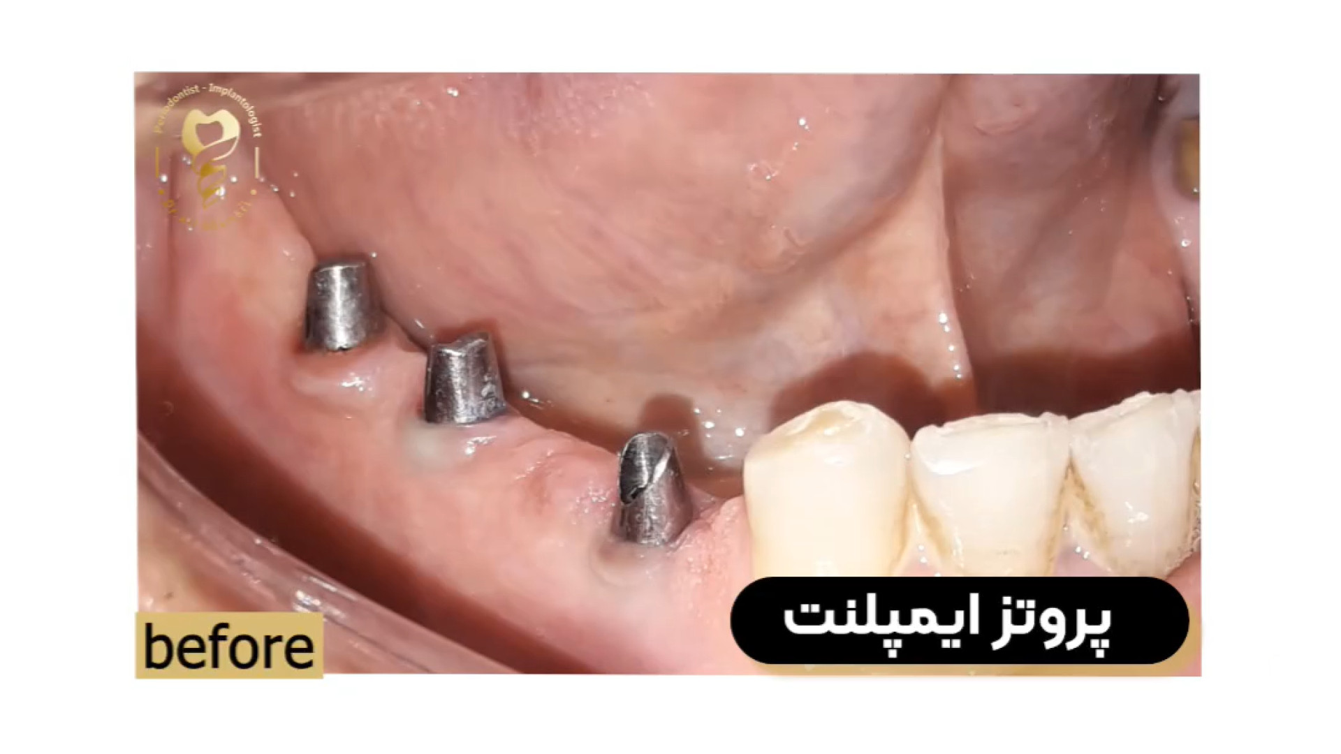 نتیجه پروتز دندان دکتر علی قمری - متخصص جراحی لثه و ایمپلنت