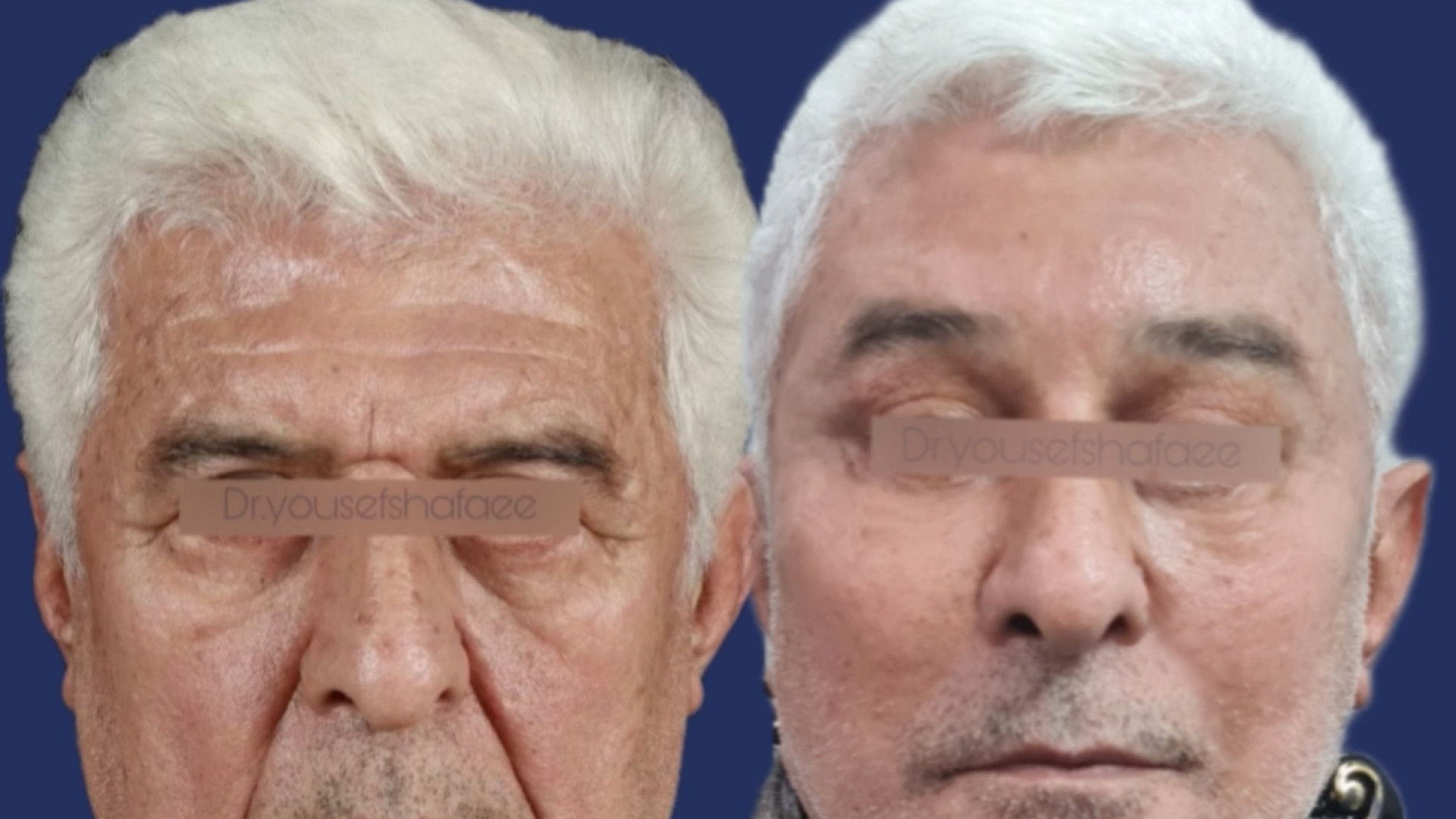 لیفت صورت و گردن | دکتر یوسف شفائی خانقاه ایمپلنت مغز-ماشین