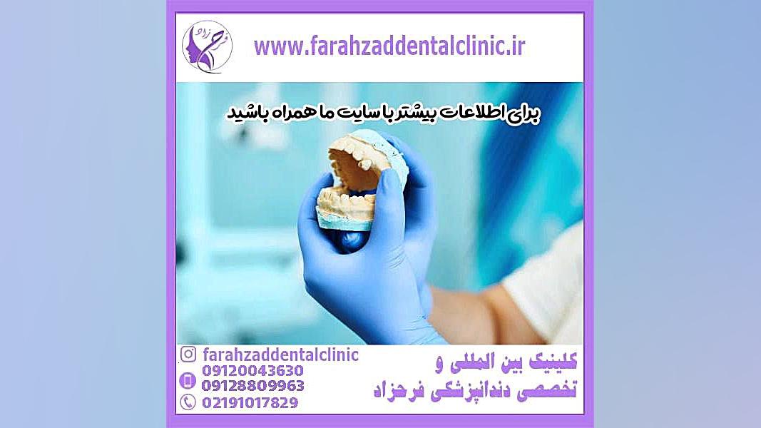 قالب گیری برای روکش دندان دستگاه بیومتریک پوشیدنی