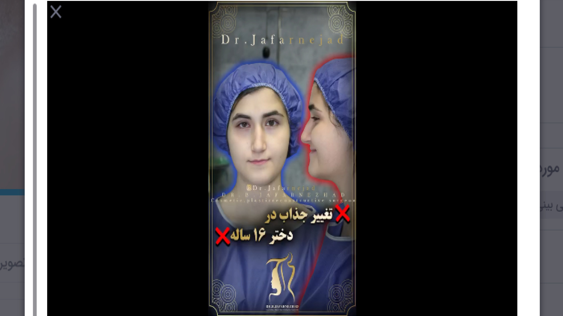 تغییر جذاب بعد عمل بینی دکتر بابک جعفرنژاد
