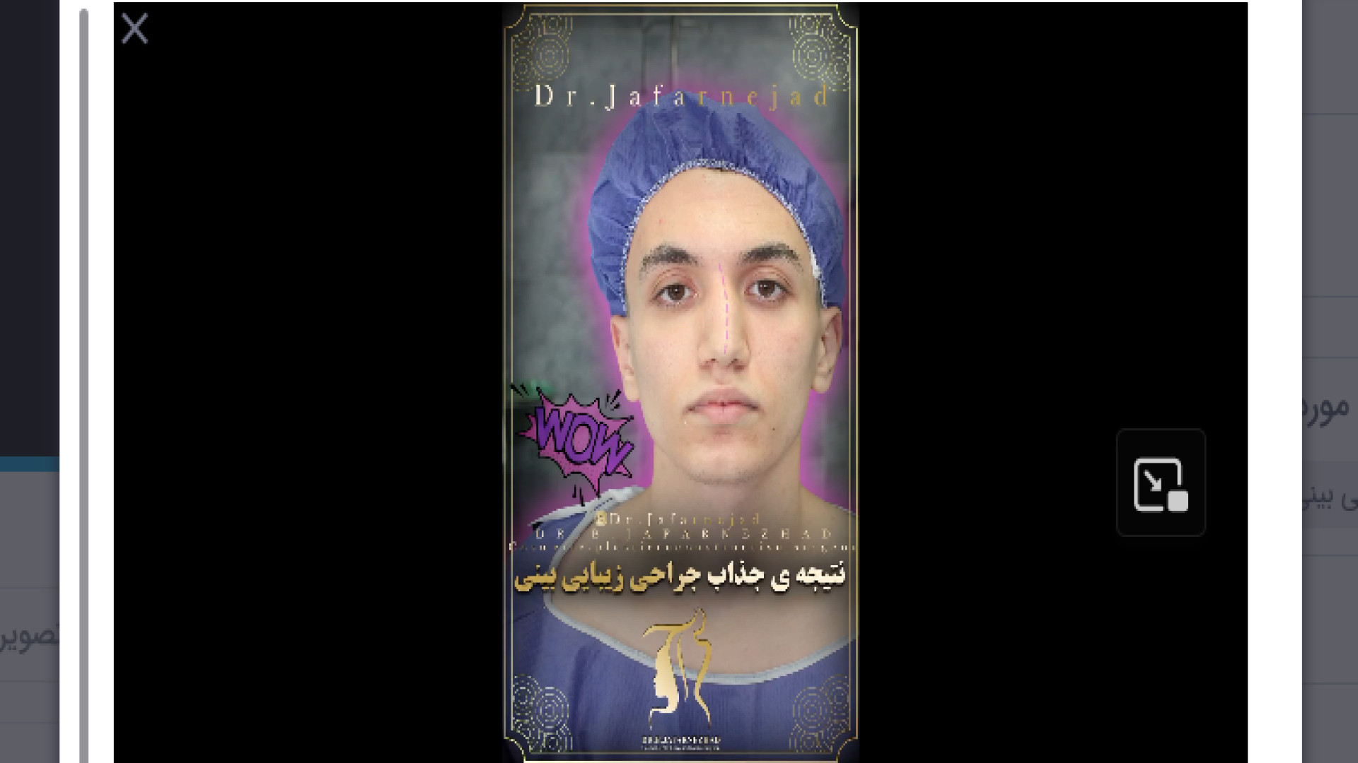 عمل بینی طبیعی دکتر بابک جعفرنژاد