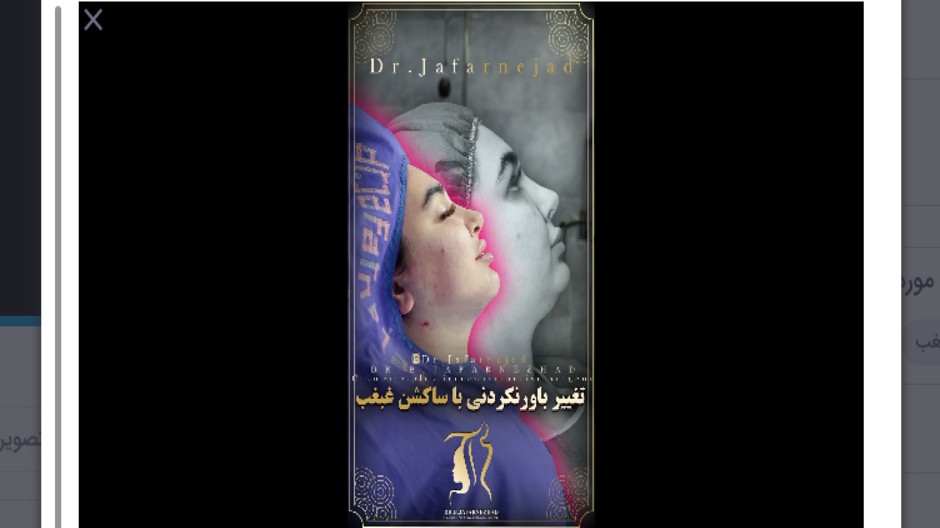 ساکشن غبغب زیباجوی عزیز ما دکتر بابک جعفرنژاد