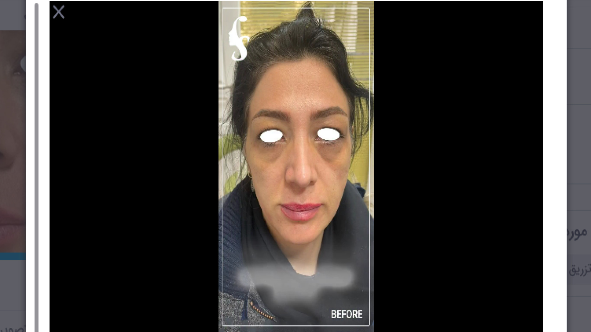 تزریق فیلر به صورت دکتر سار ا لطفی