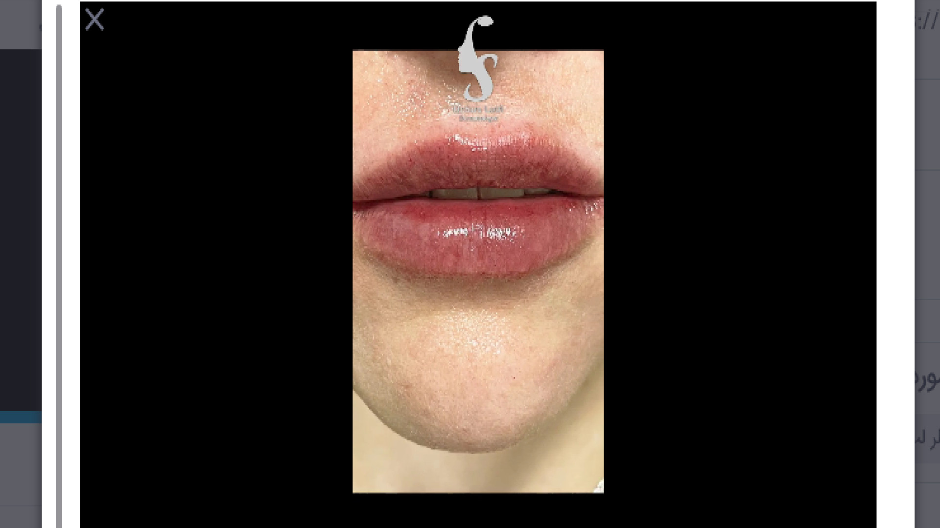 تزریق فیلر لب دکتر سار ا لطفی