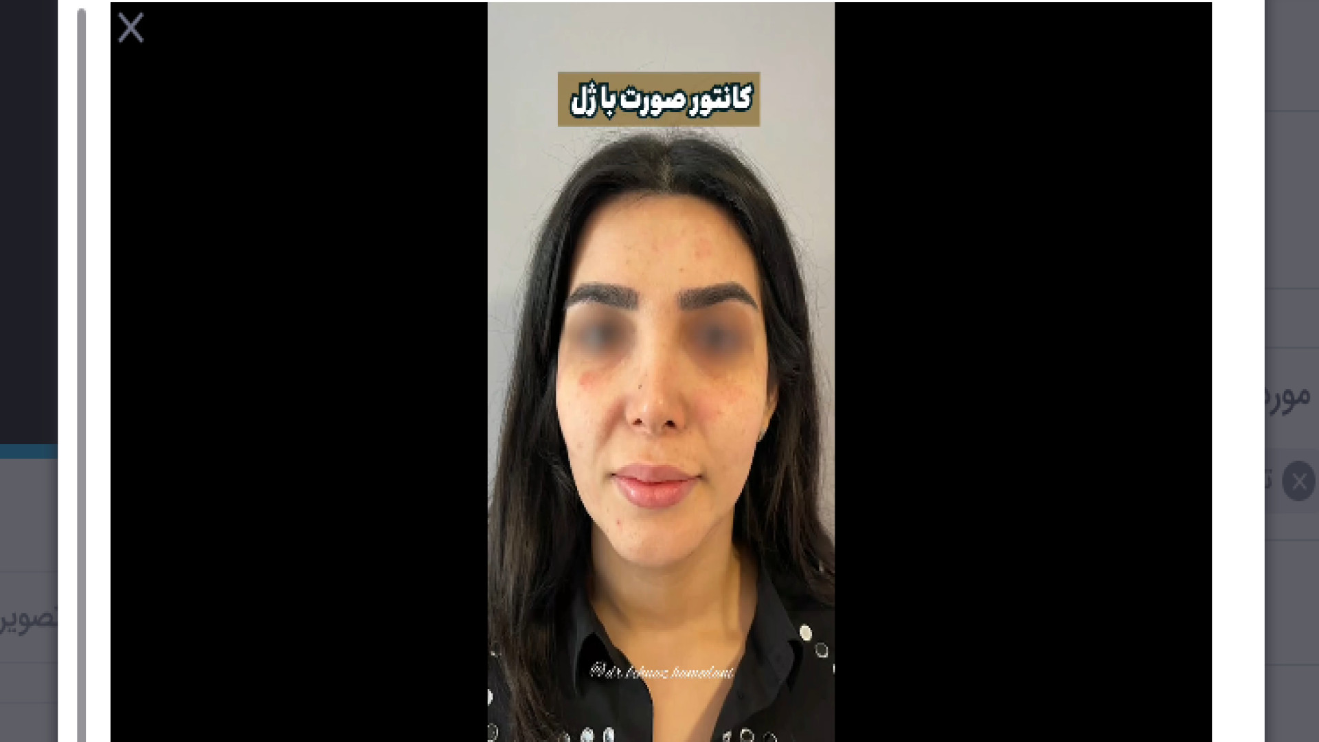 کانتور صورت با ژل دکتر بهناز همدانی - متخصص پوست، مو و زیبایی