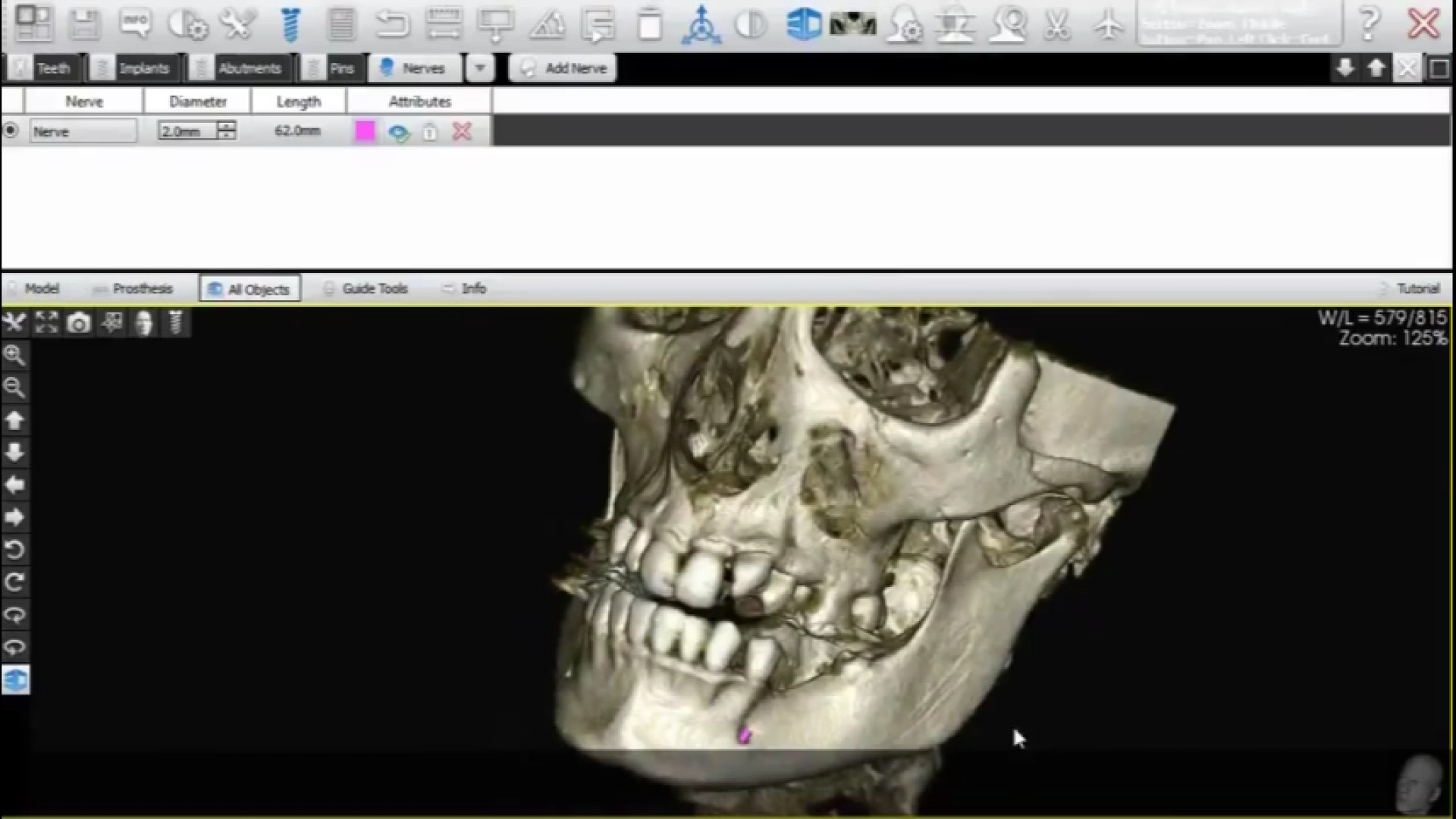 آموزشCBCT :ترسیم عصب مندیبولار به وسیله نرم‌افزار CBCT دندانپزشکی لیفت ابرو