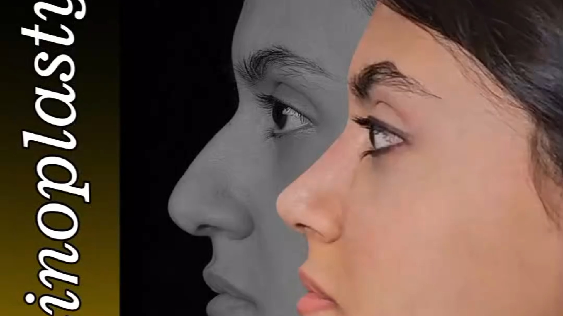 یک ماه بعد از جراحی بینی نچرال با قوس کم دکتر علی عقیلی - جراح بینی در تهران