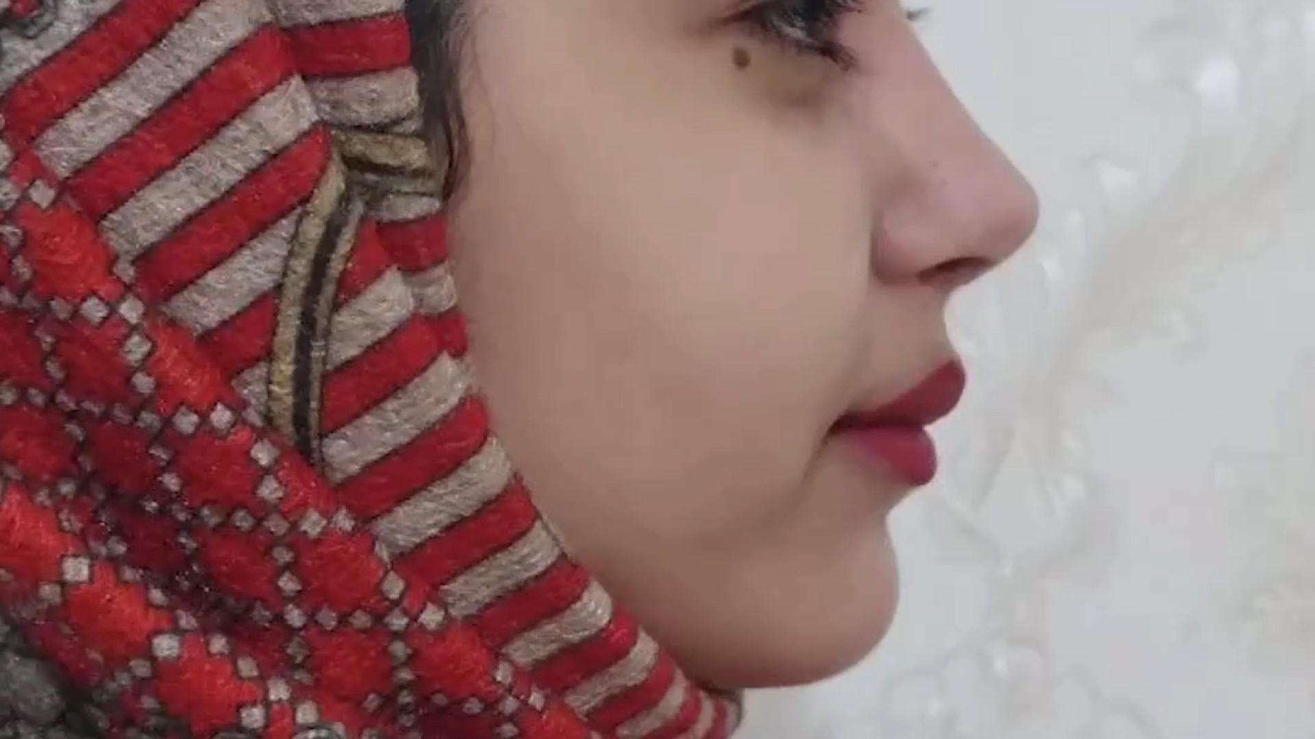 عمل بینی گوشتی دکتر فاطمه مختاری فر جراح بینی در لرستان