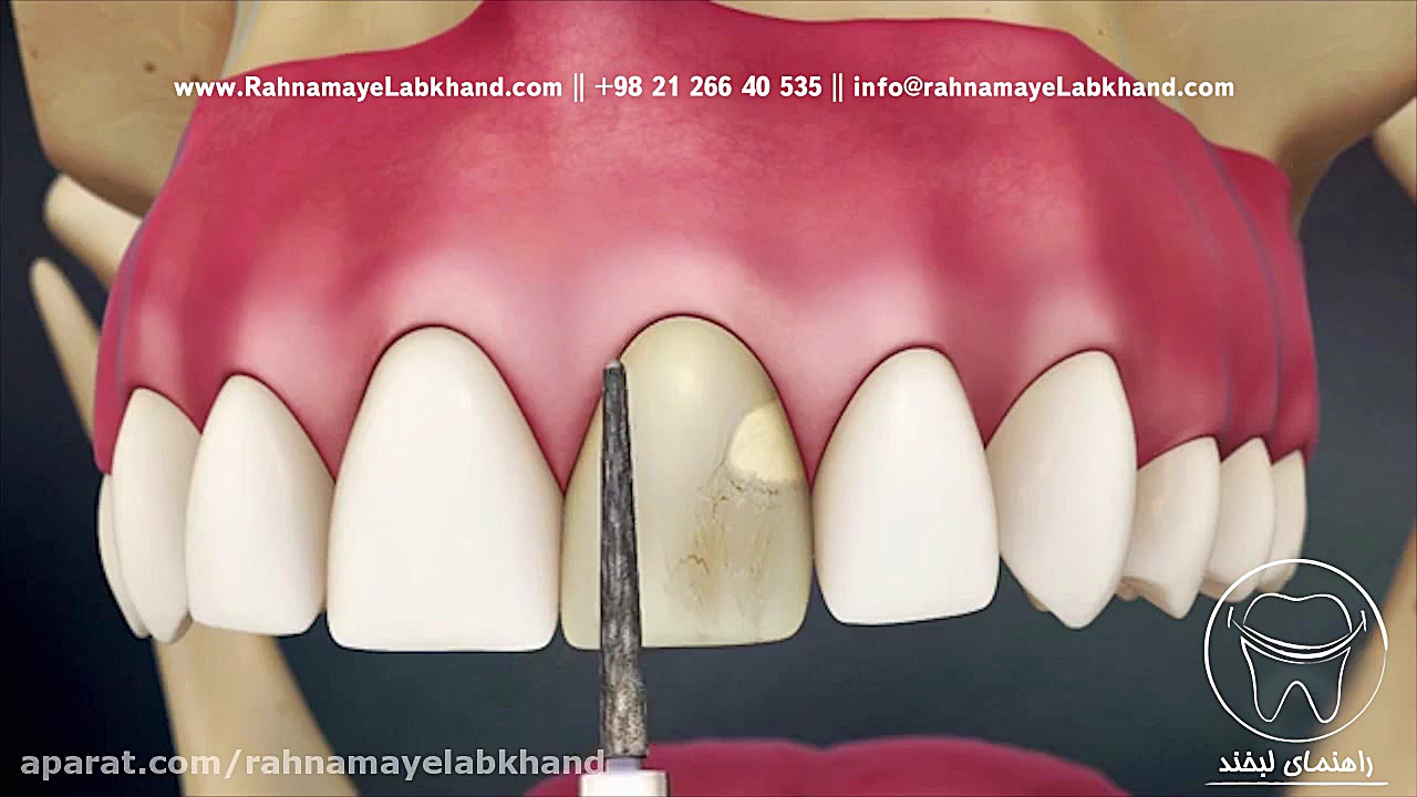 روکش دندان هموکروماتوز