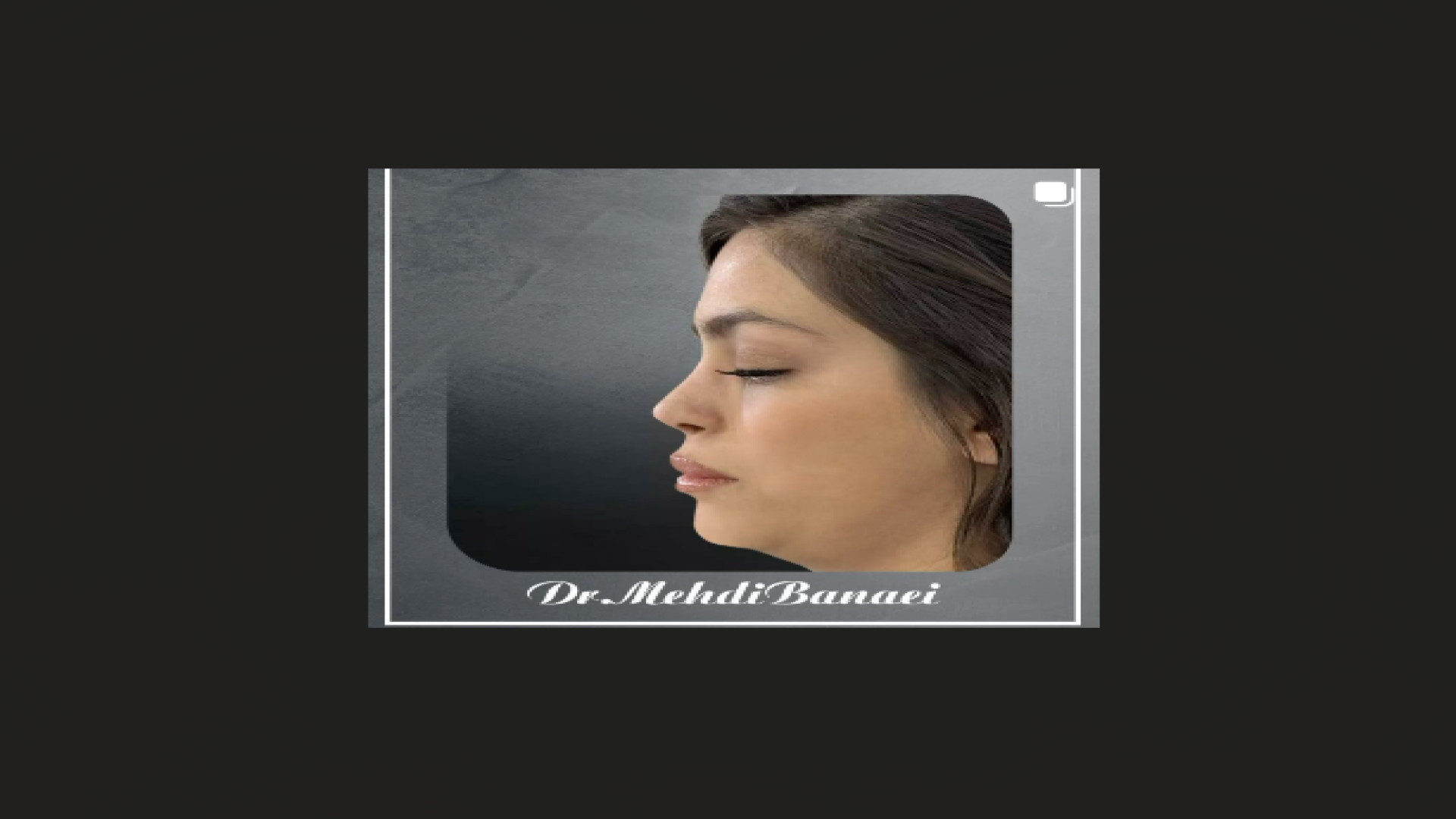 نتیجه جراحی بینی