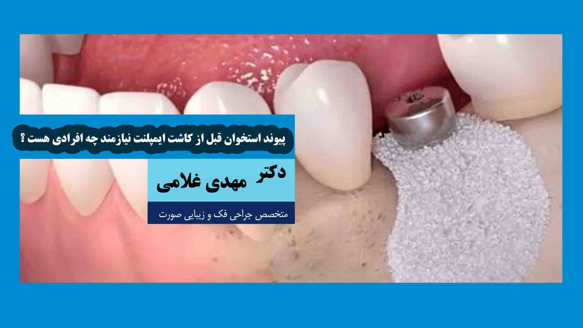 چه افرادی قبل از کاشت ایمپلنت نیازمند پیوند استخوان هستند؟ دکتر مهدی غلامی