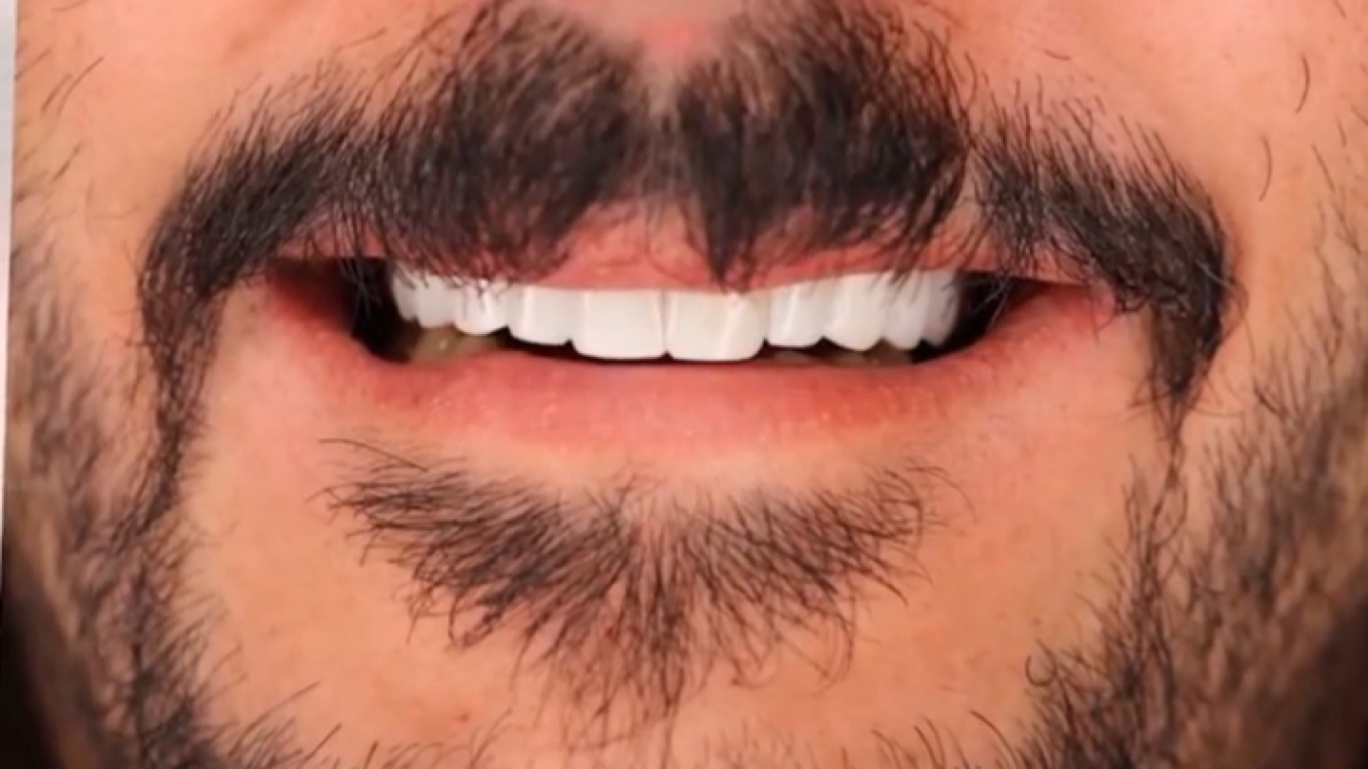 کامپوزیت دندان دکتر ندا هادی-دندانپزشک زیبایی