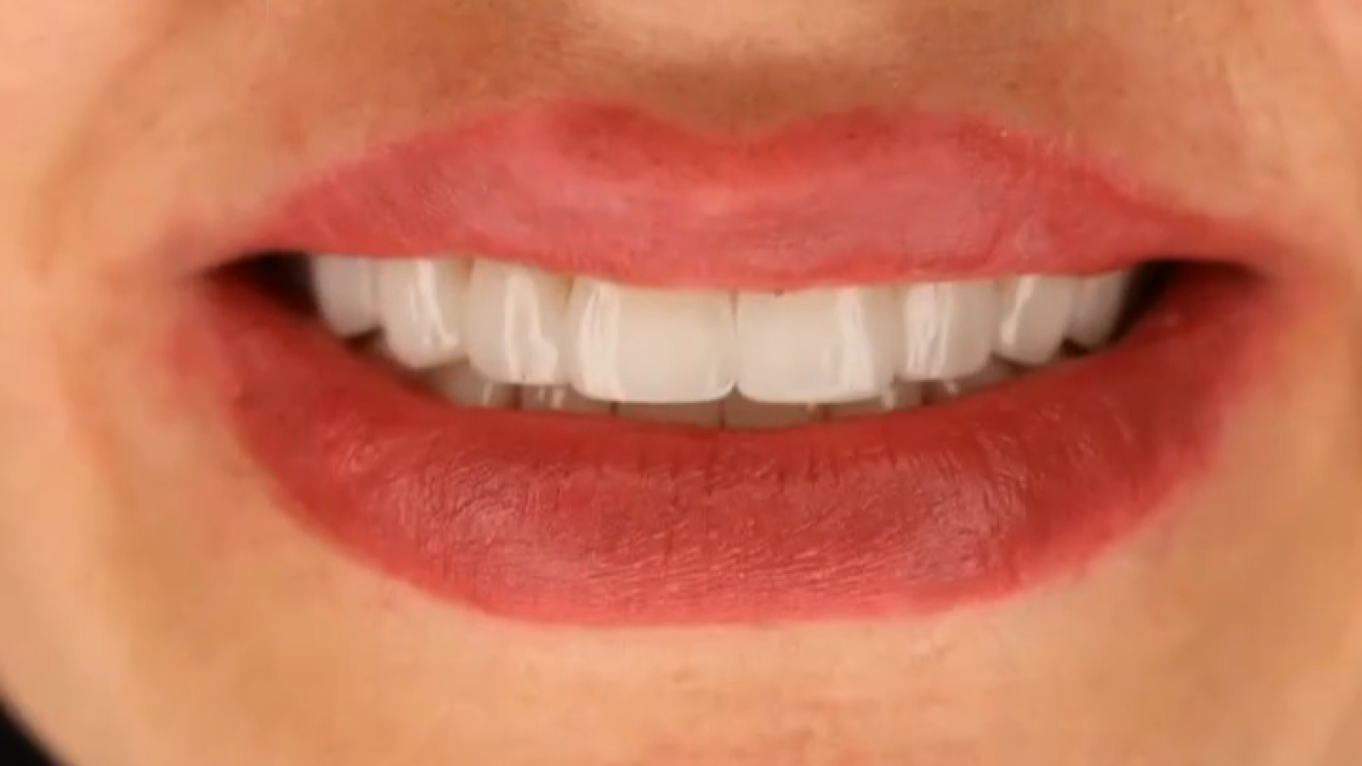 نمونه کار دکتر ندا هادی دکتر ندا هادی-دندانپزشک زیبایی