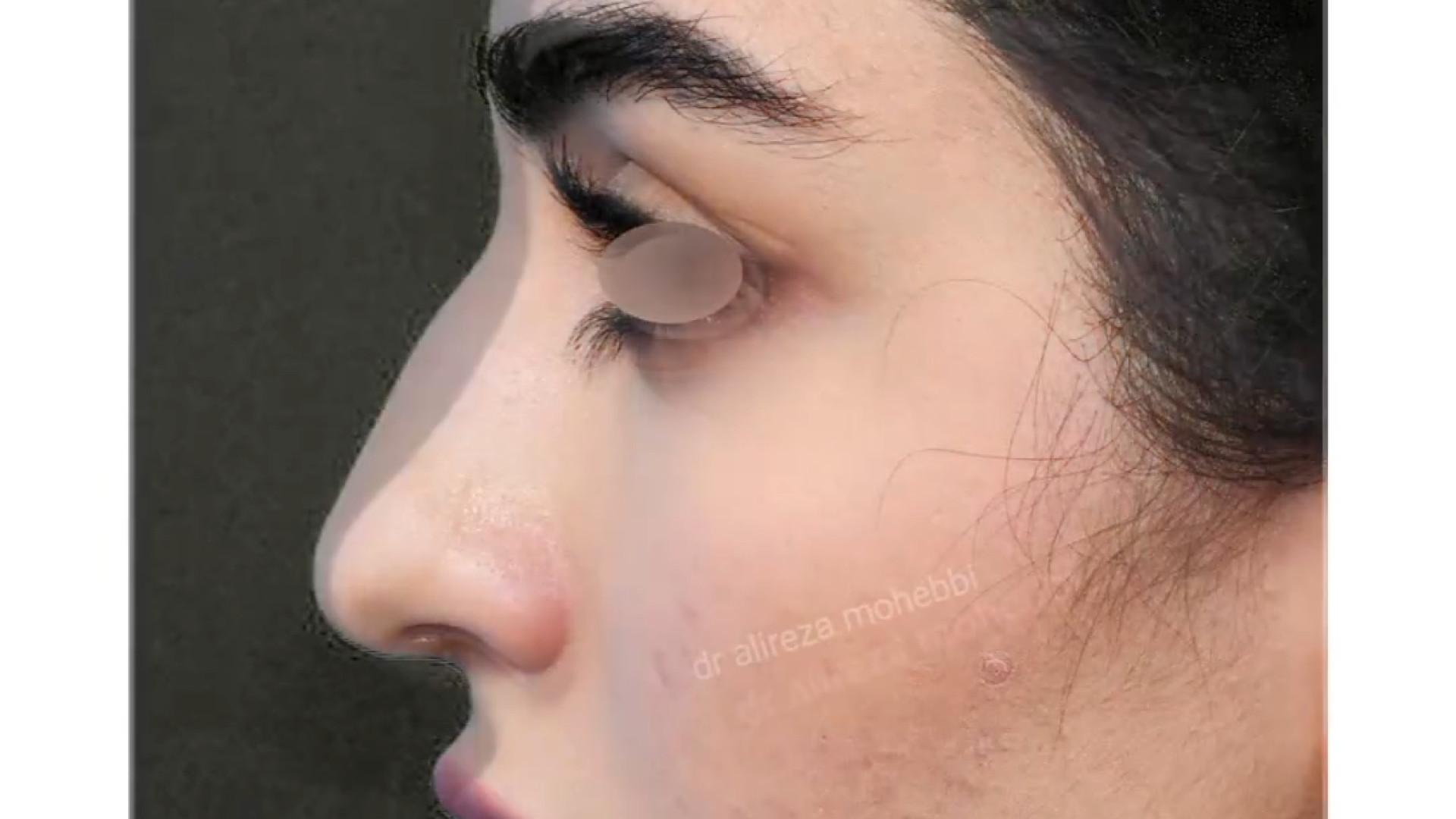 سه ماه بعد از جراحی بینی با تیپ بولبوس