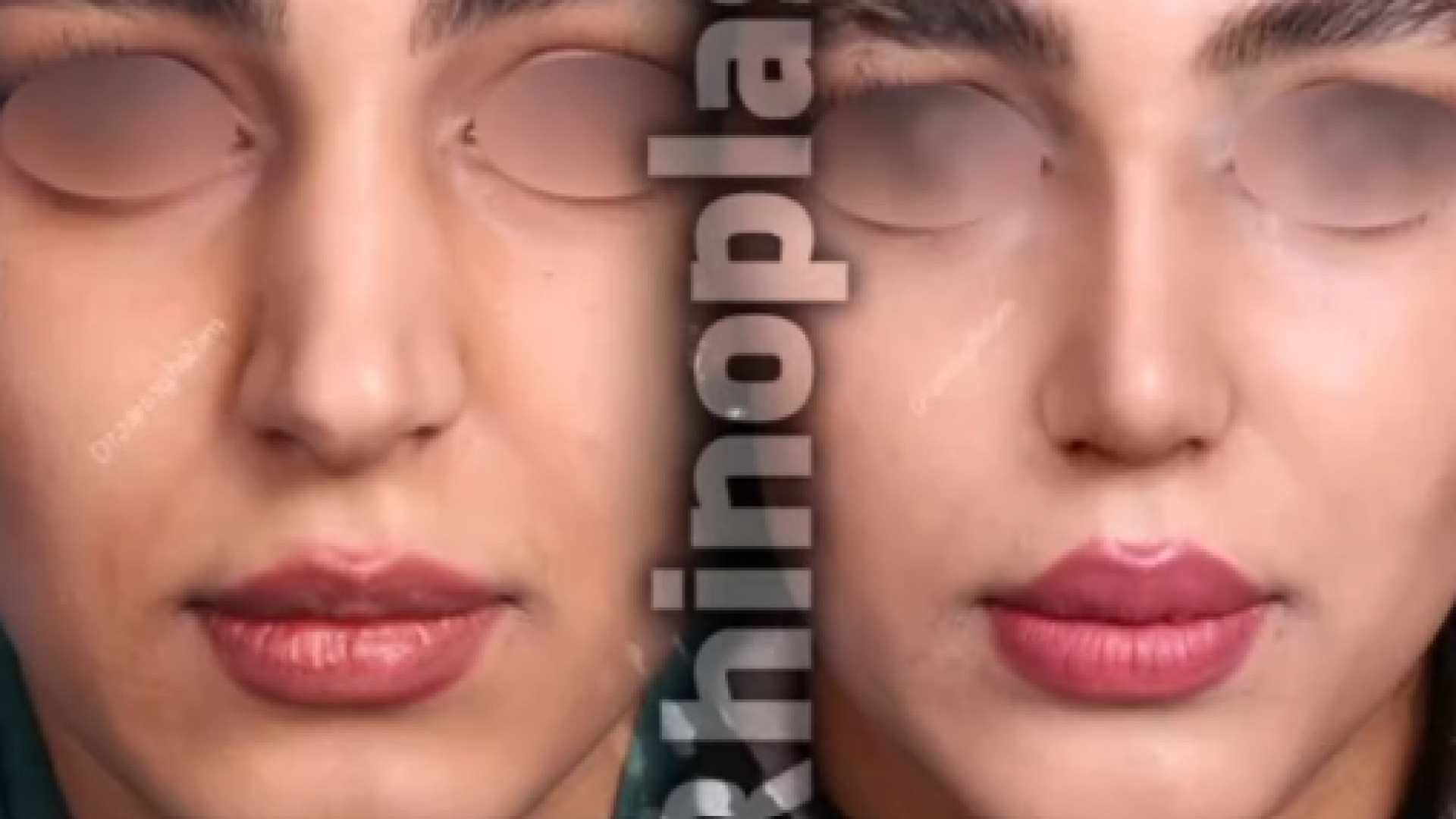 یک ماه بعد ازجراحی بینی
