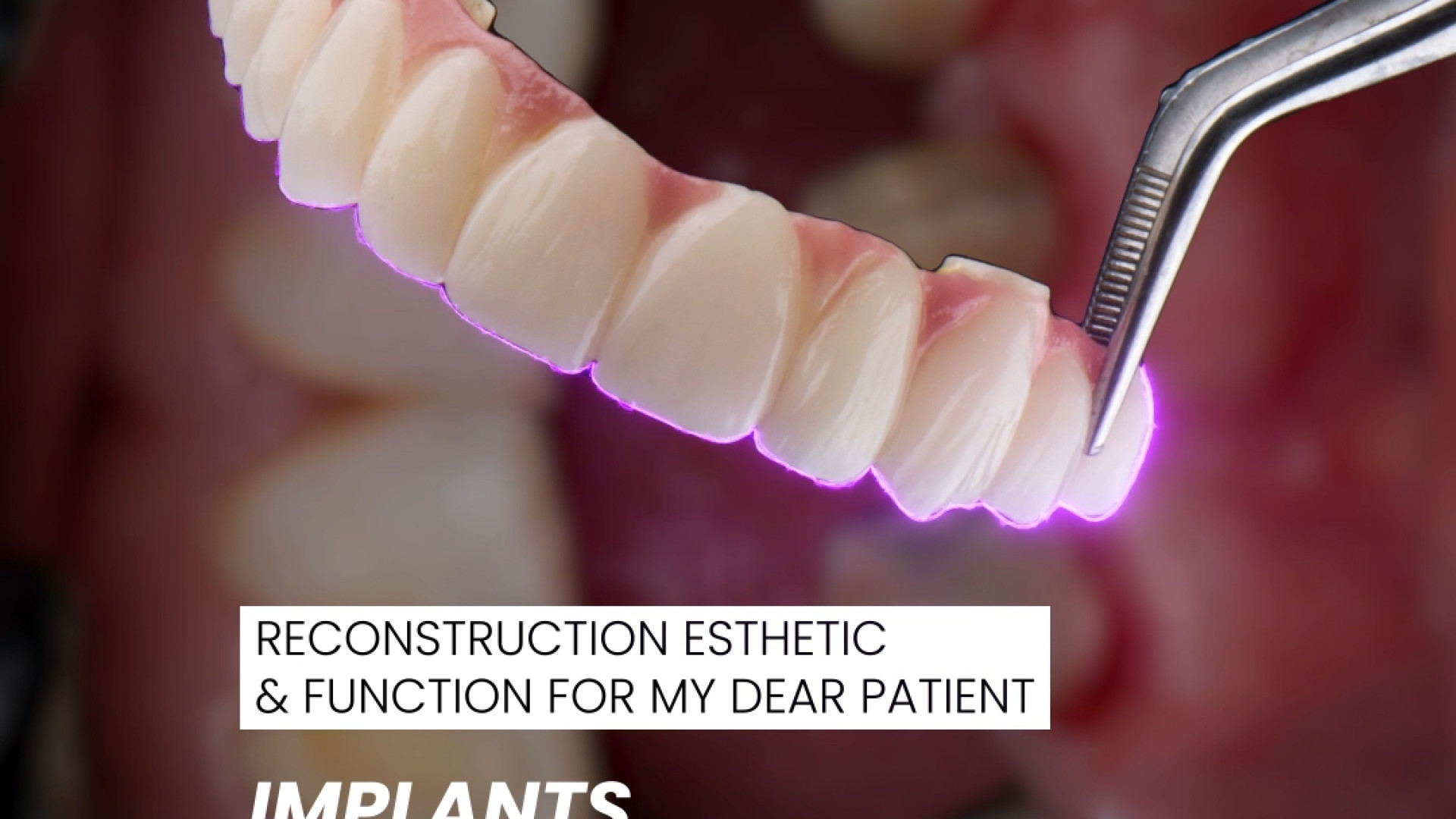 دندانهای زیبا - لبخندی با اعتماد بنفس دکتر فرانک اصل رسولی