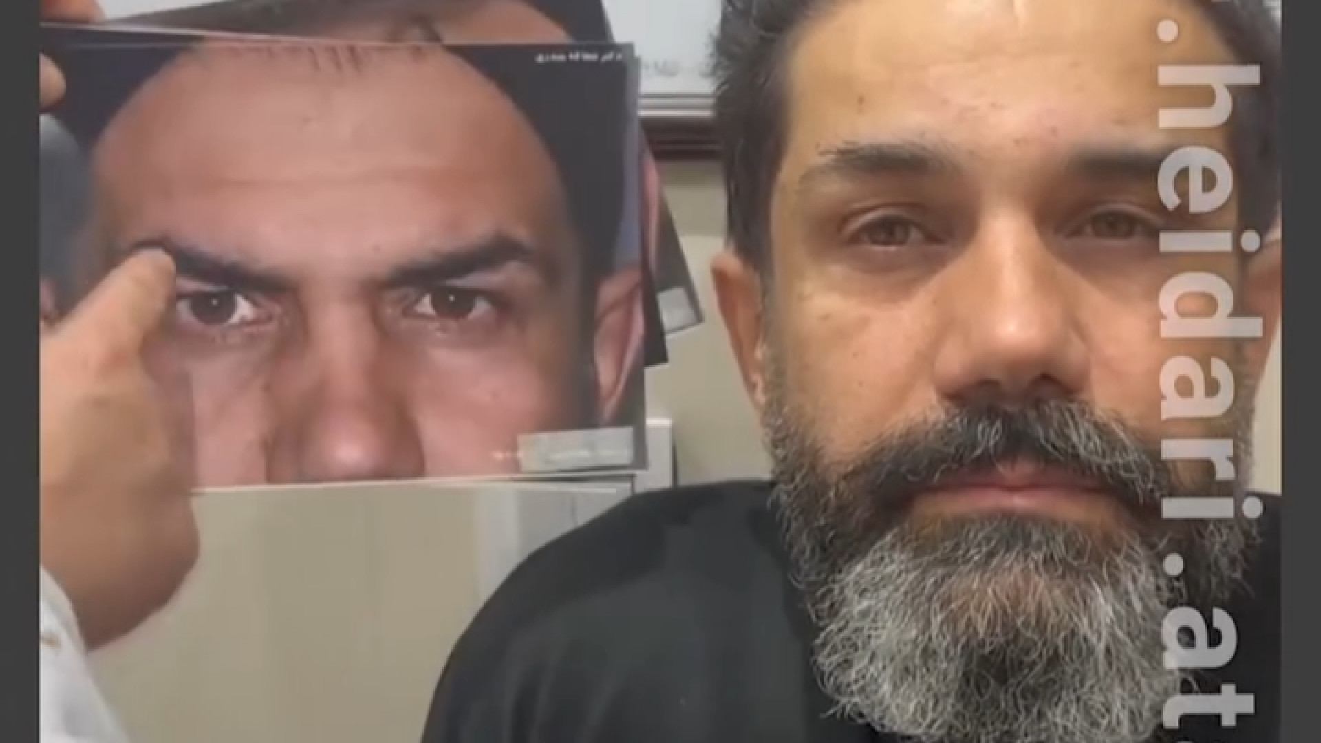 لیفت آندوسکوپی پیشانی و بلفاروپلاستی کربوکسی تراپی