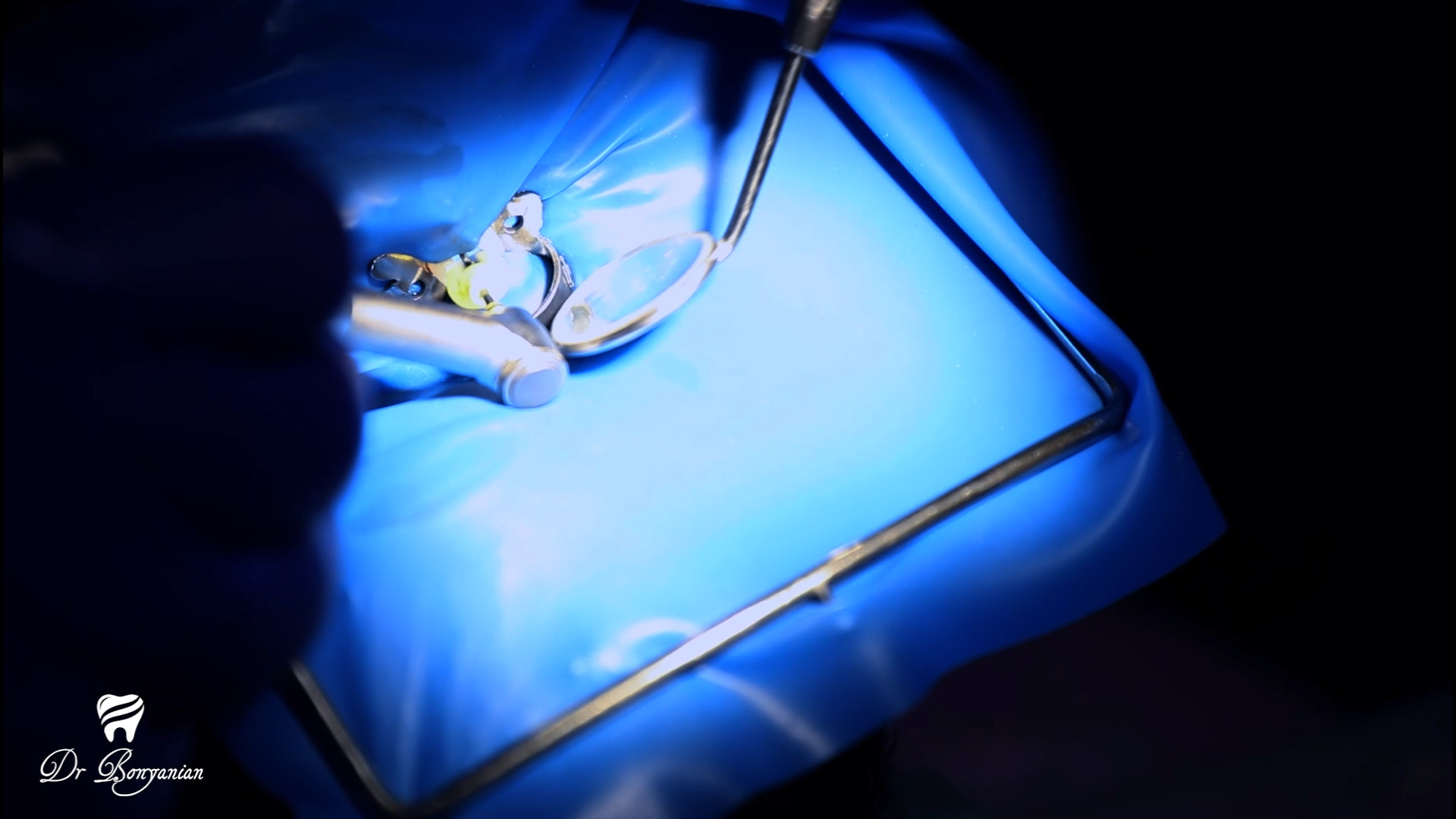فیلم عصب کشی دندان - دندانپزشکی دکتر بنیانیان پرمترکسد