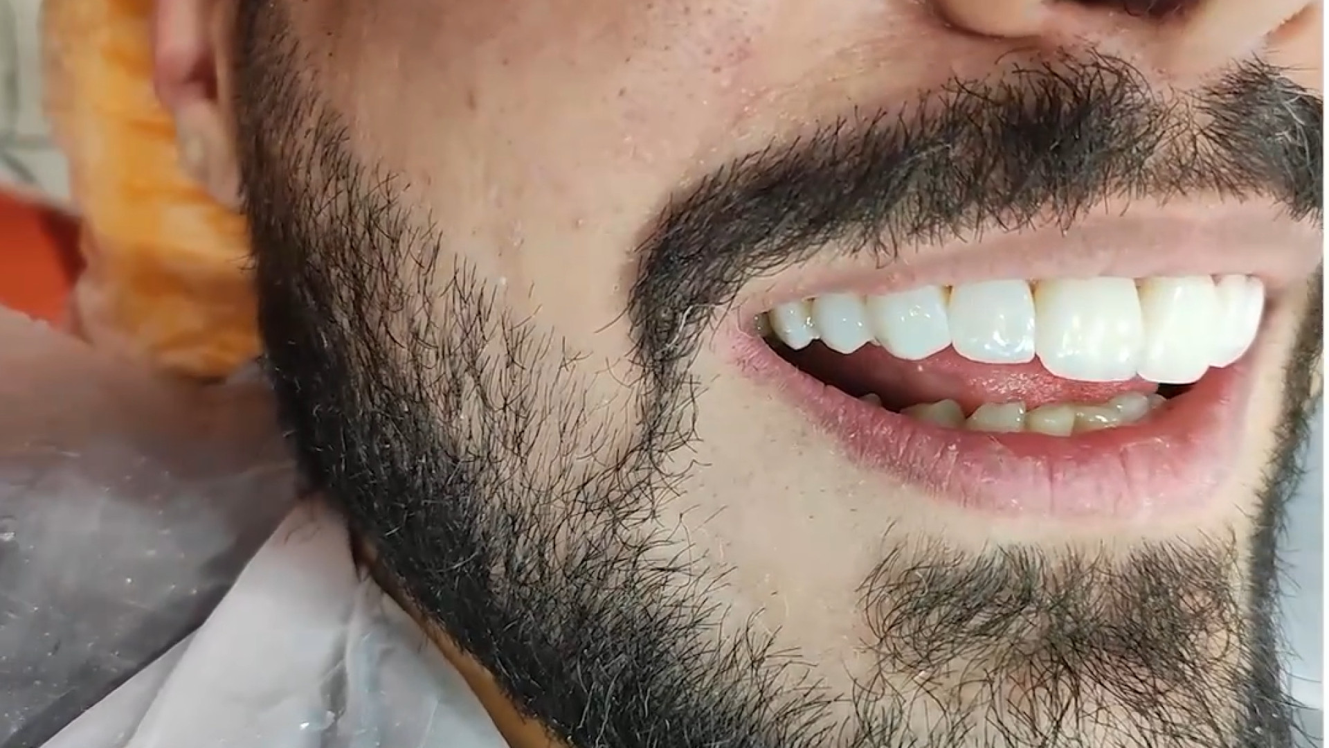 نمونه کار کامپوزیت ونیر دکتر زهرا رخ فروز