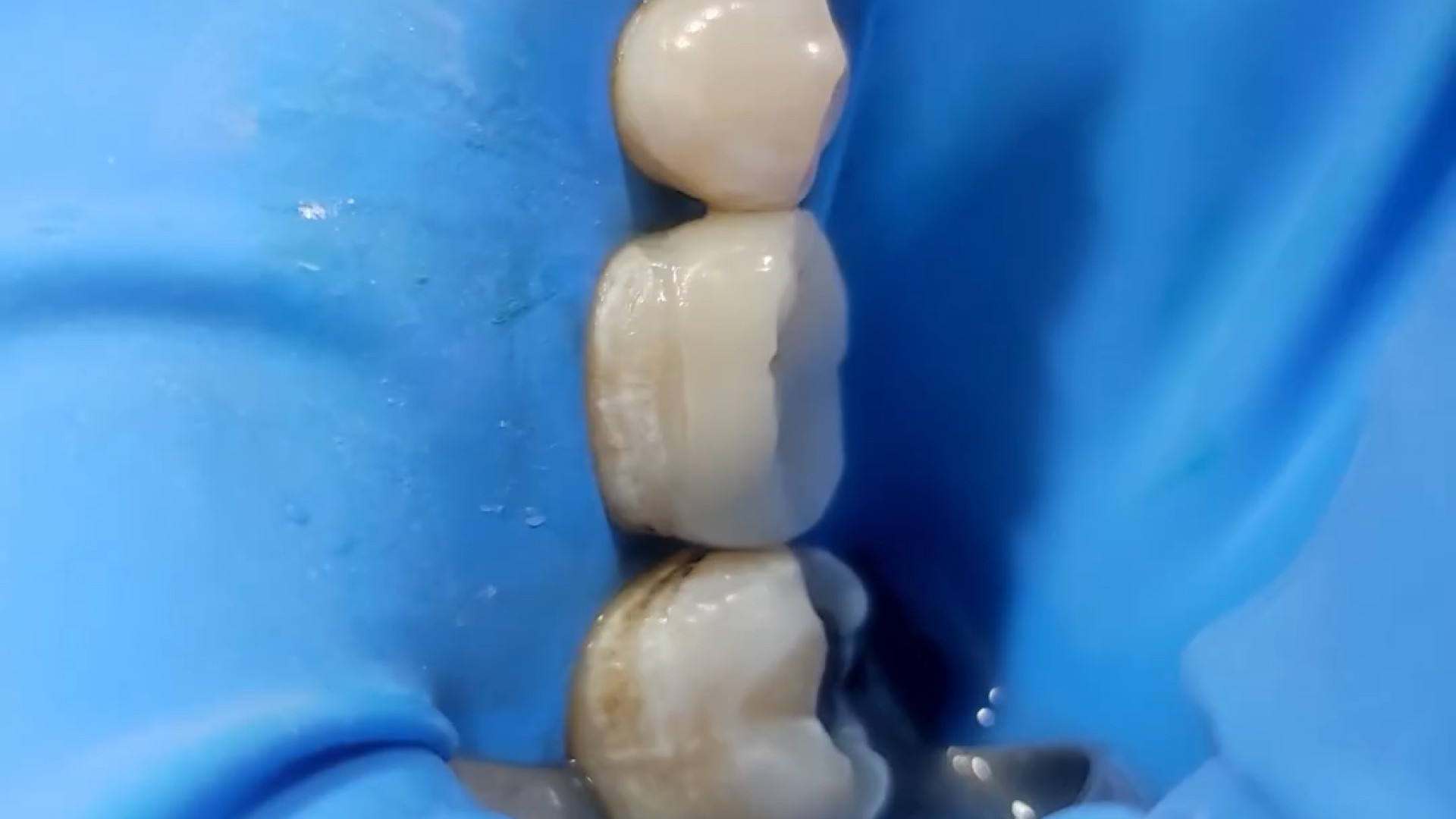 نجات دندان به روش آنله/ اورلی دکتر زهرا رخ فروز