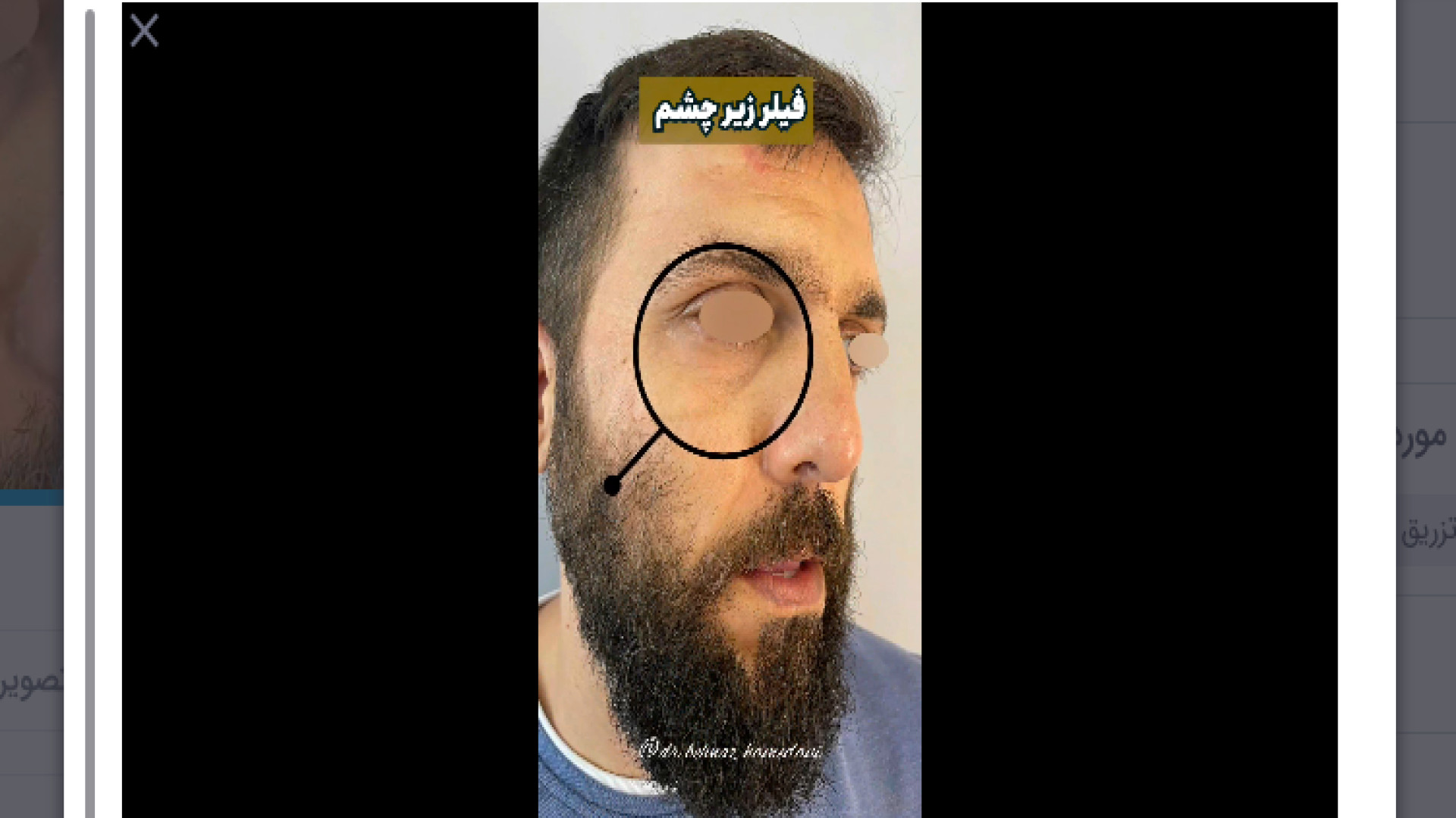 نمونه کار تزریق فیلر زیر چشم دکتر بهناز همدانی - متخصص پوست، مو و زیبایی
