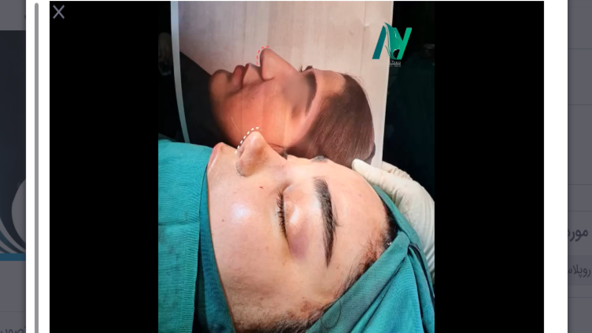 بلافاصله بعد از عمل رینوپلاستی و لیفت پیشانی دکتر محمودرضا اصحاب یمین - فوق تخصص پلاستیک