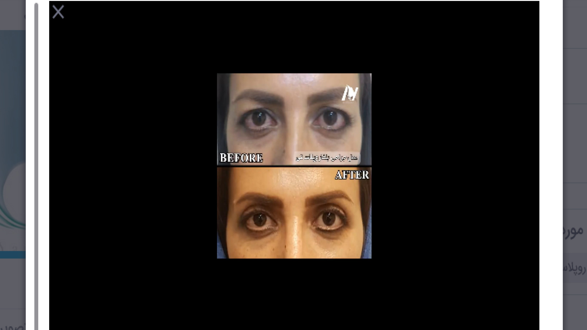 نمونه کار بلفاروپلاستی دکتر محمودرضا اصحاب یمین - فوق تخصص پلاستیک