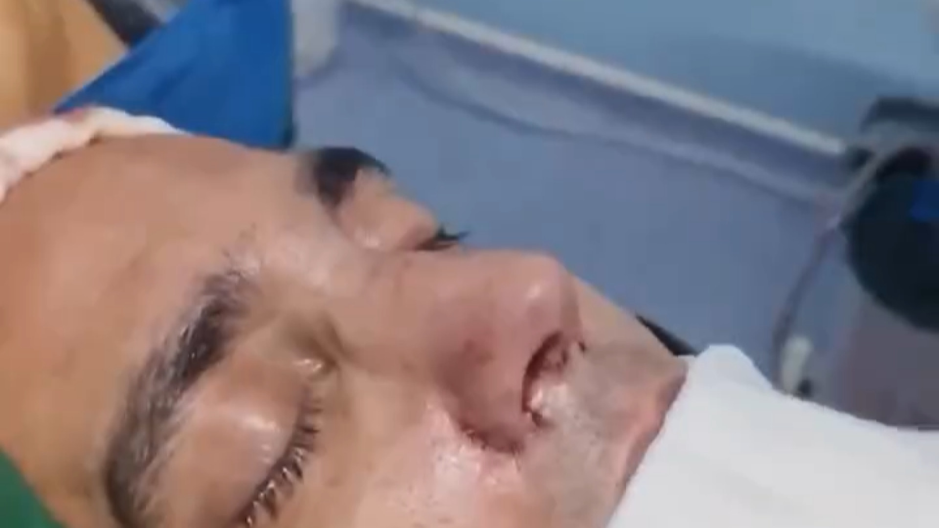 جراحی بینی طبیعی مردانه دکتر شاهین بهجو - فوق تخصص جراحی پلاستیک