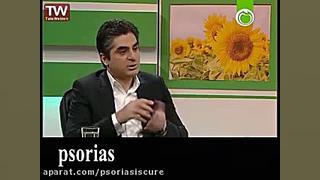 عوامل بروز و تشدید پسوریازیس چیست؟ کامپوزیت ونیر