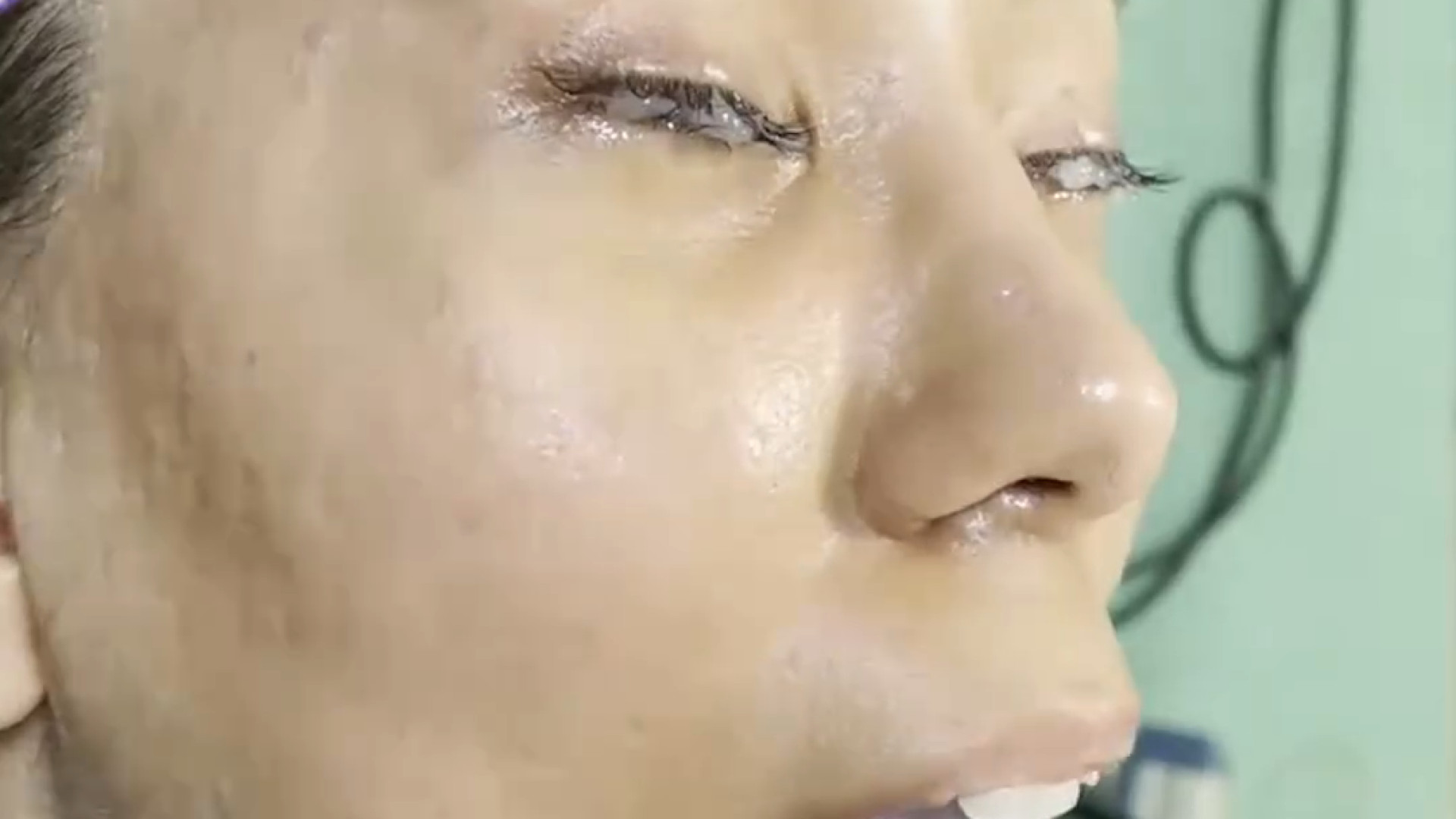 تزریق چربی صورت و لب و زاویه سازی صورت ️ دکتر حمید رضا فتحی فوق تخصص جراحی پلاستیک