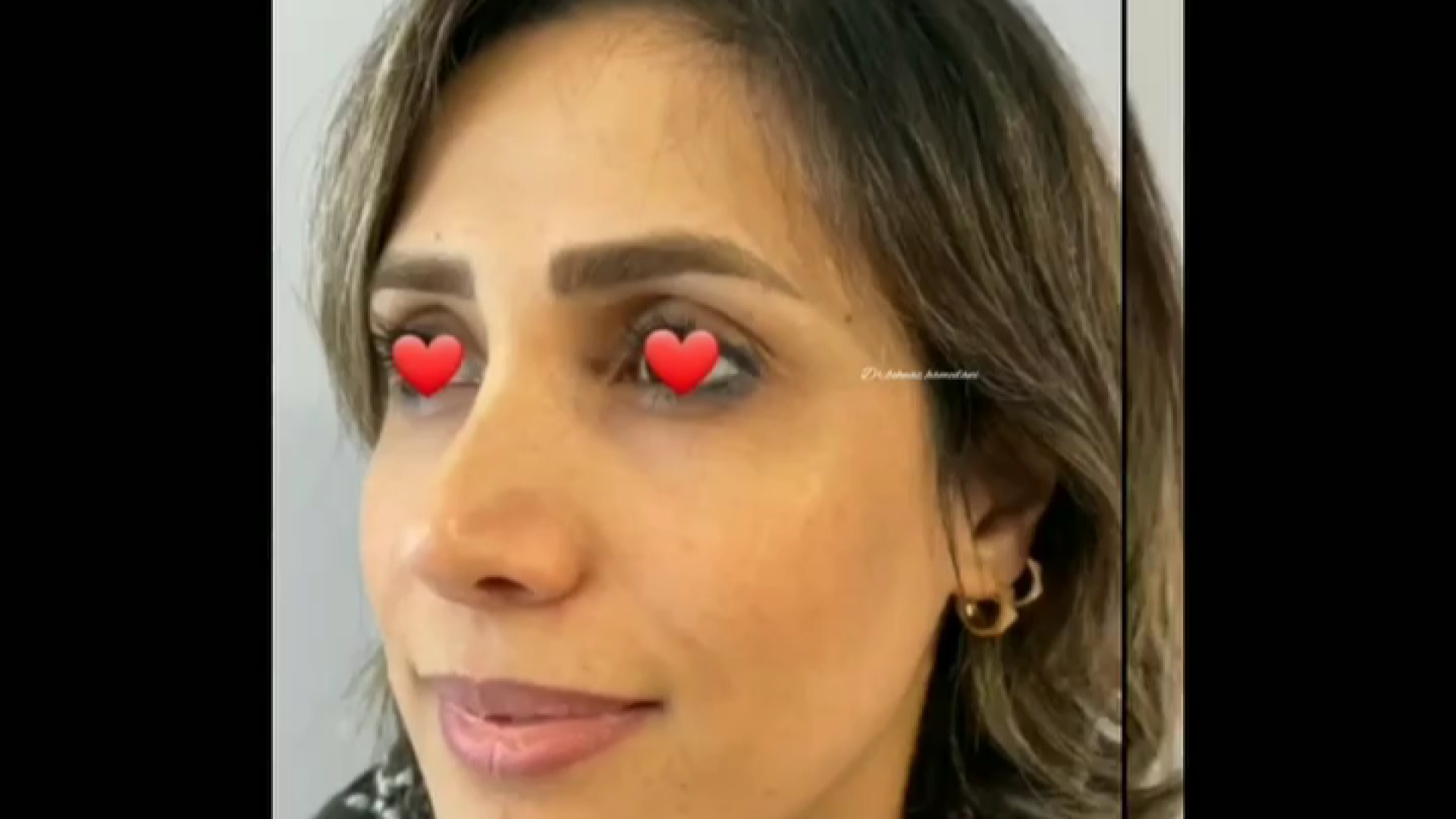 تزریق فیلر صورت دکتر بهناز همدانی - متخصص پوست، مو و زیبایی