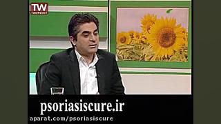 آیا پسوریازیس باعث مرگ و یا کاهش عمر می شود؟ گیمر