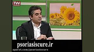 آیا طب سوزنی در درمان پسوریازیس موثر است؟ دست و پا چلفتی