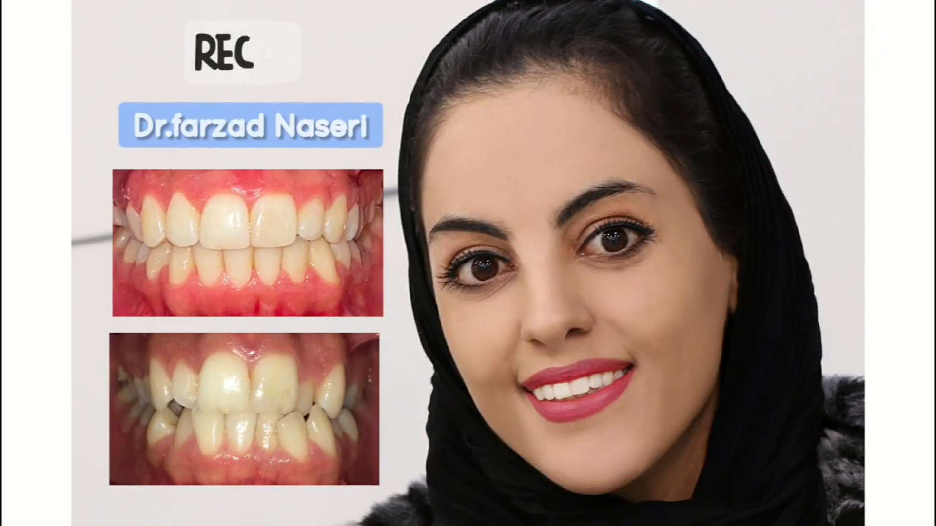 ارتودنسی ثابت دو فک دکتر فرزاد ناصری متخصص ارتودنسی در اصفهان