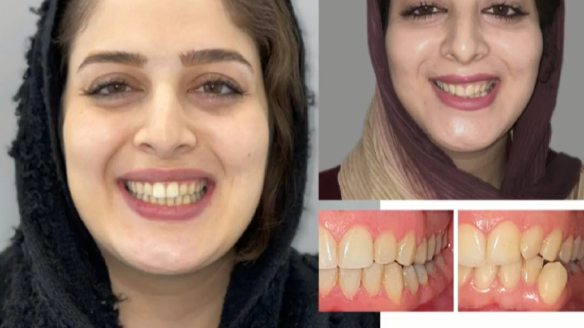 ارتودنسی ثابت بدون کشیدن دندان دکتر فرزاد ناصری متخصص ارتودنسی در اصفهان