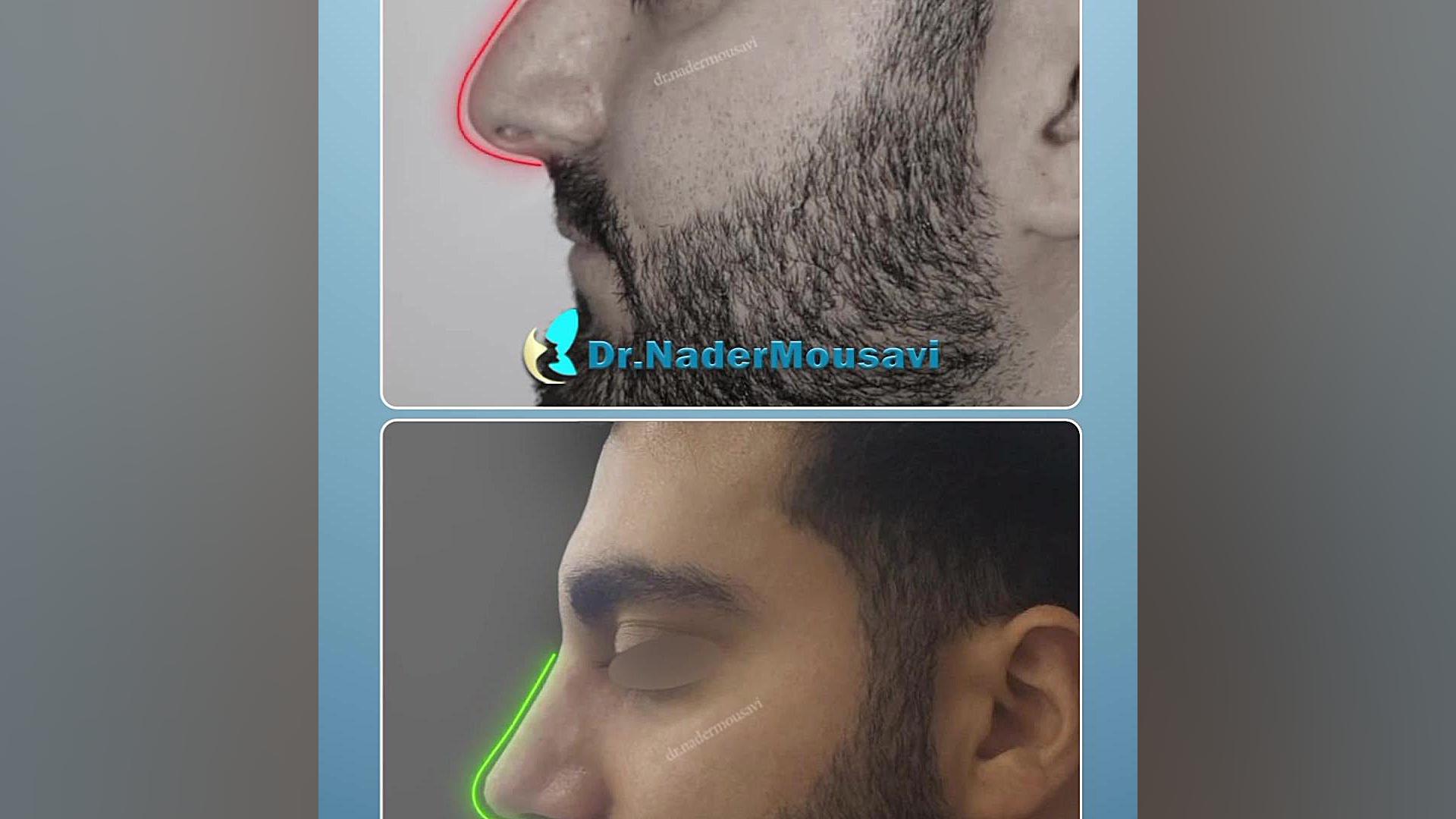 بینی مردونه یعنی این ، طبیعی و زیبا بیماری بهجت