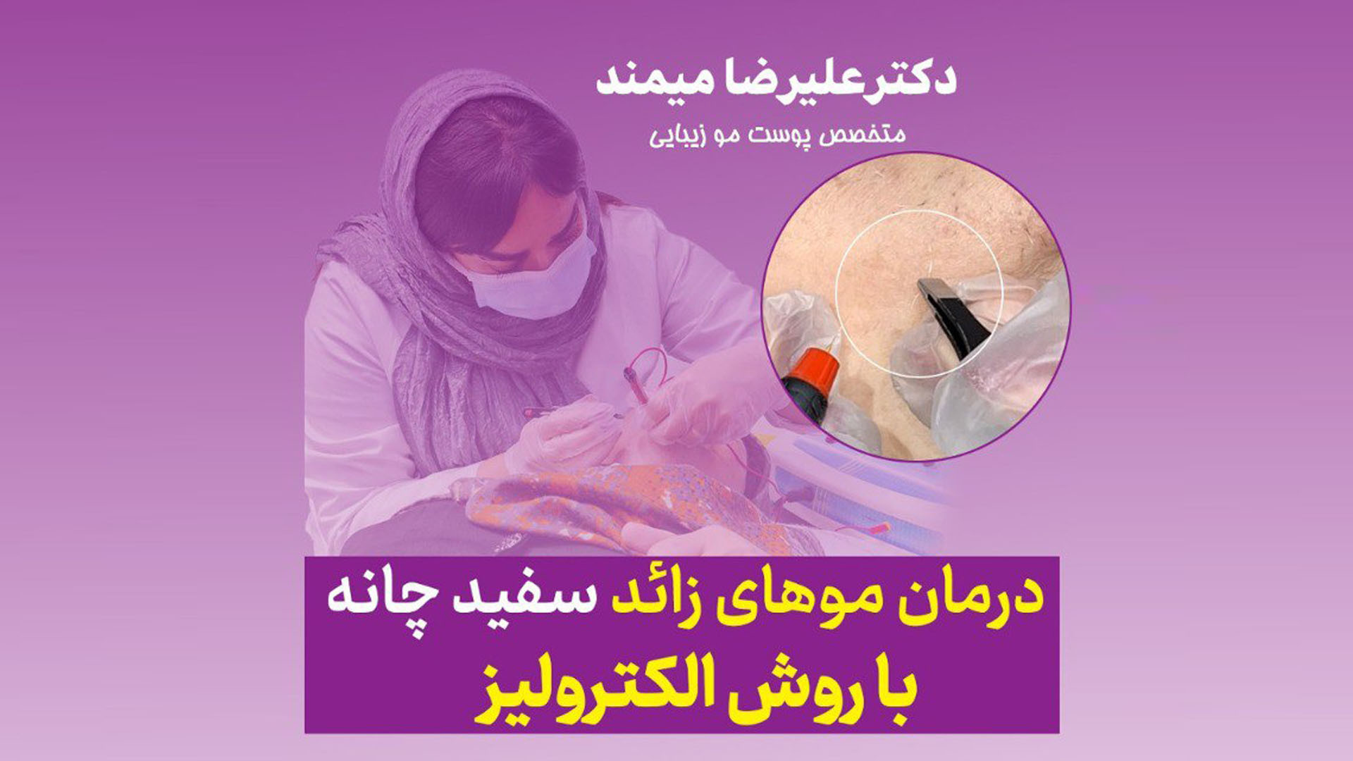 الکترولیز موهای زائد سفید چانه لیزر موهای زائد کرج دکتر میمند هایپوپاراتیروئیدیسم