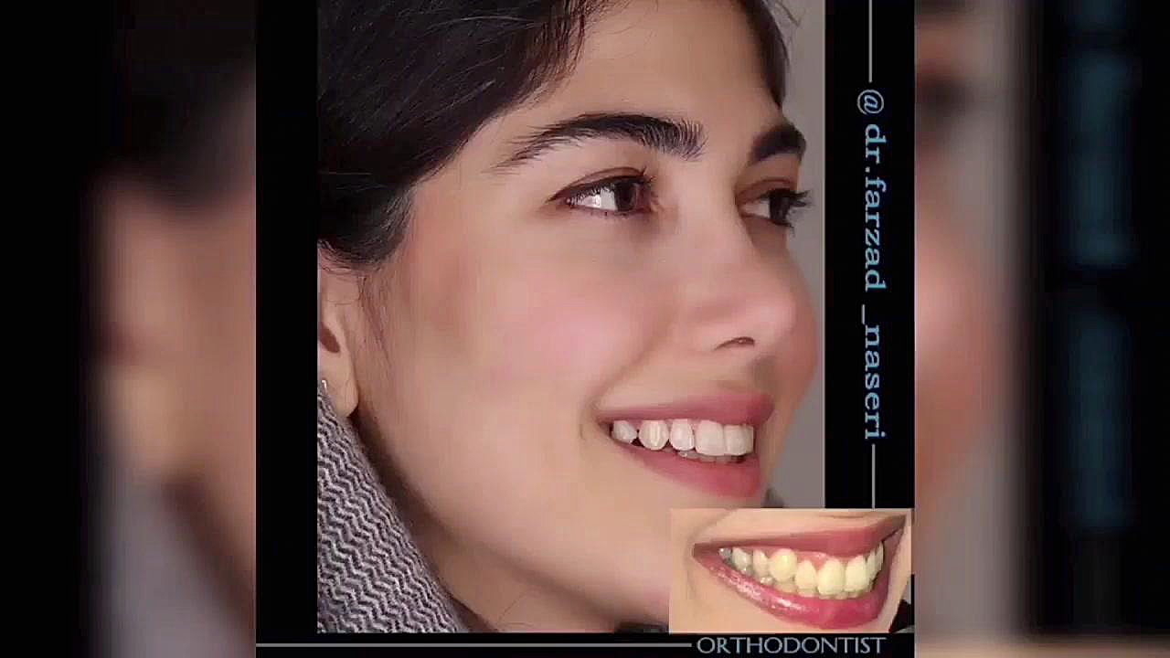 ارتودنسی فک بالا دکتر فرزاد ناصری متخصص ارتودنسی در اصفهان