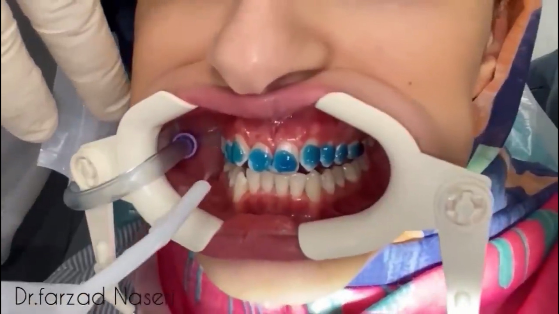فیلم نصب براکت ارتودنسی دکتر فرزاد ناصری متخصص ارتودنسی در اصفهان