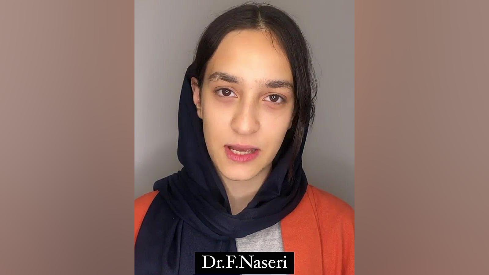 نتیجه ارتودنسی دندان نیش نهفته دکتر فرزاد ناصری متخصص ارتودنسی در اصفهان